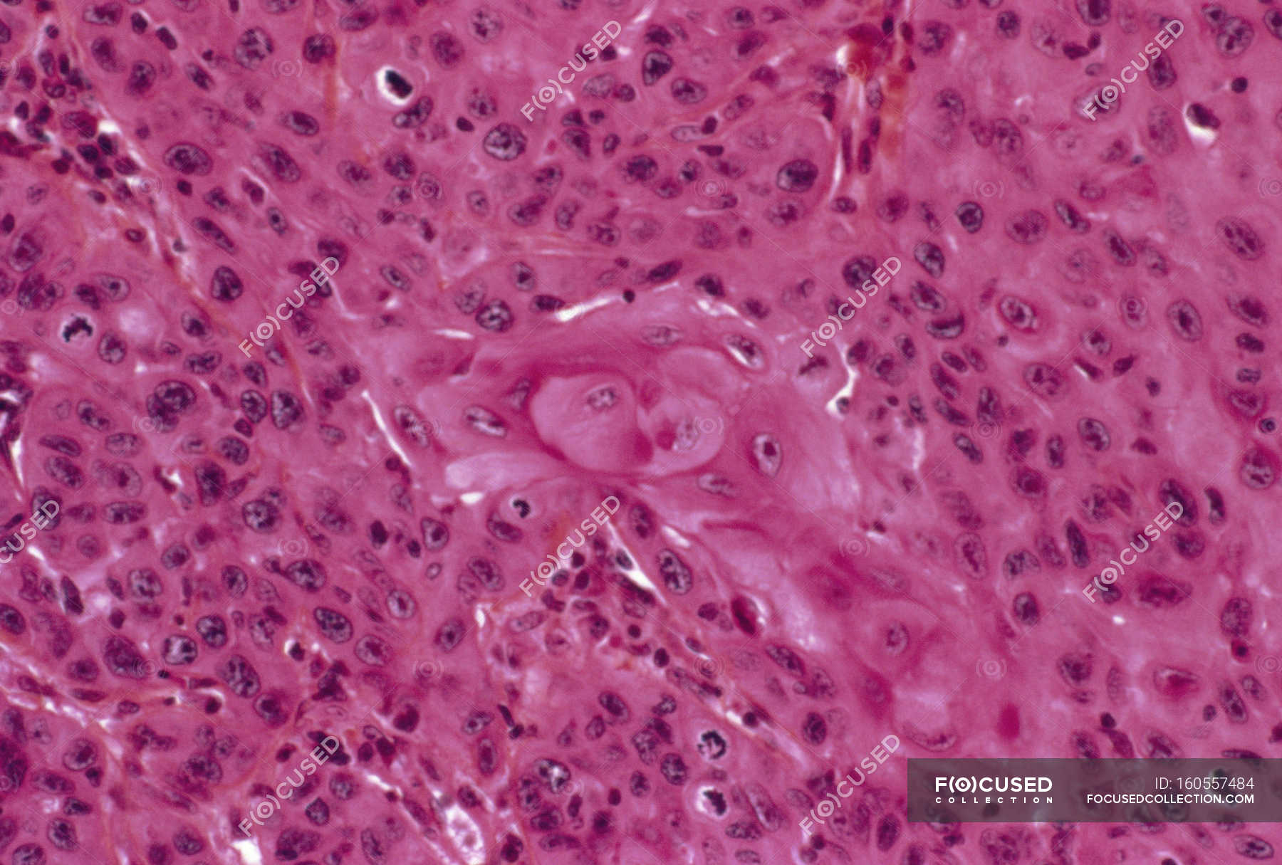 Carcinoma Epidermoide In English