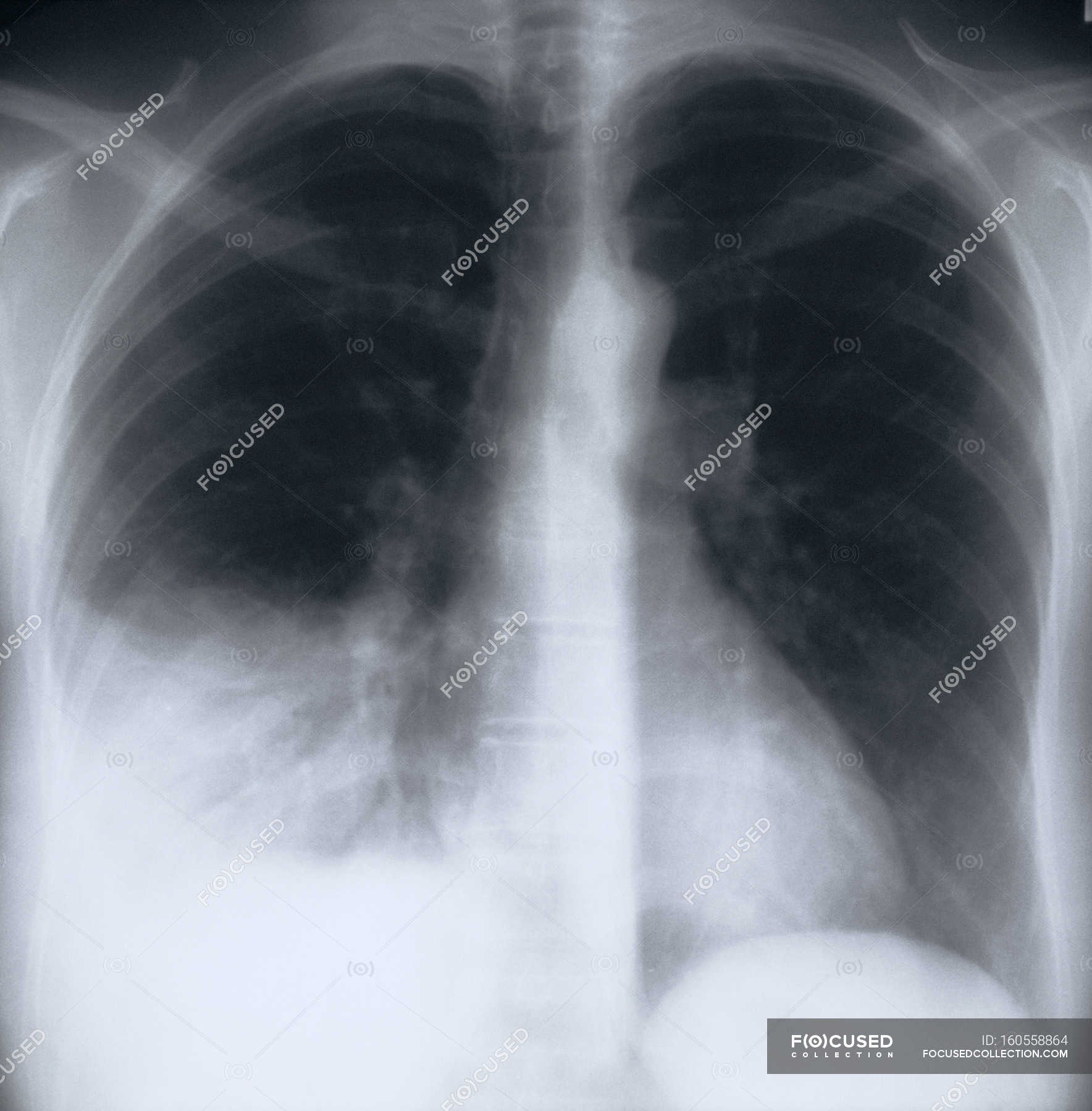 Pneumonia. X-ray of the chest of a patient with bacterial pneumonia ...