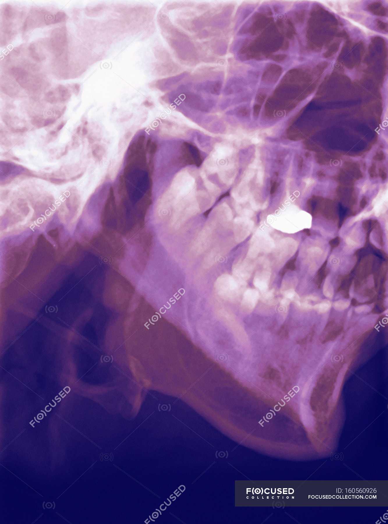 coloured-profile-x-ray-of-a-human-mandible-lower-jaw-skeleton