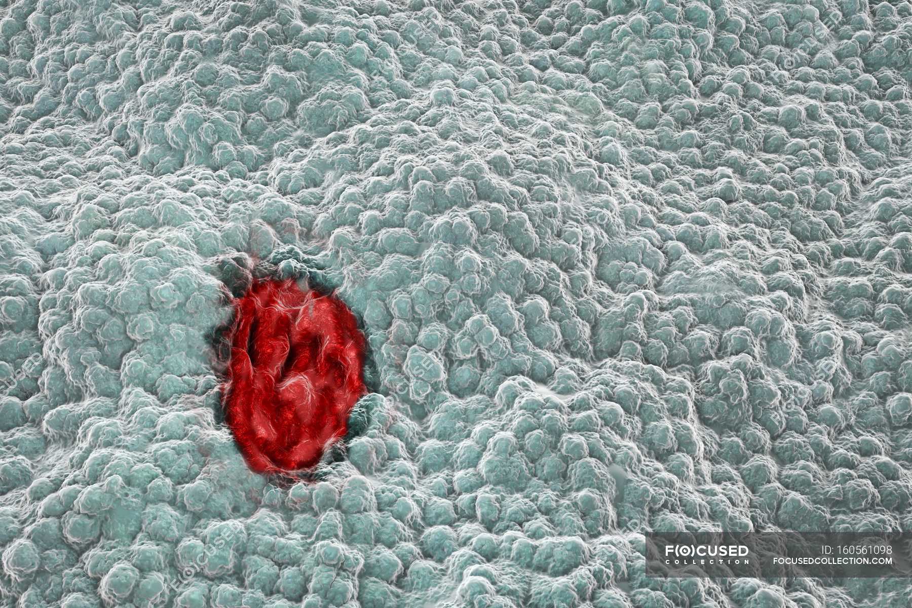Клетка язвы. Язва желудка под микроскопом. Желудок микрофотография. Малигнизированная язва.