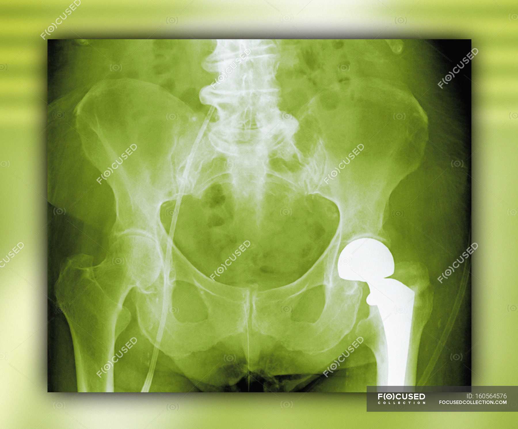 total-hip-replacement-pelvis-computer-artwork-stock-photo-160564576