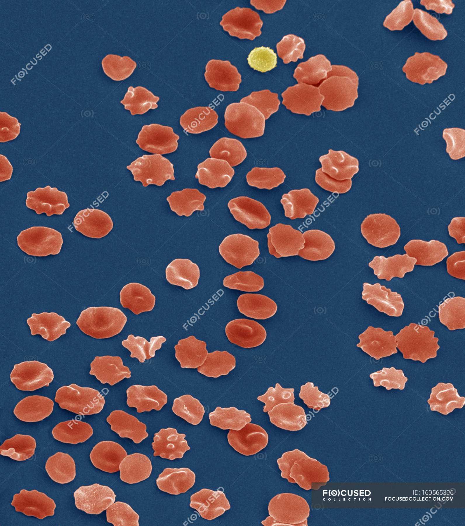 Crenated red blood cells — Micrograph, biological - Stock Photo ...