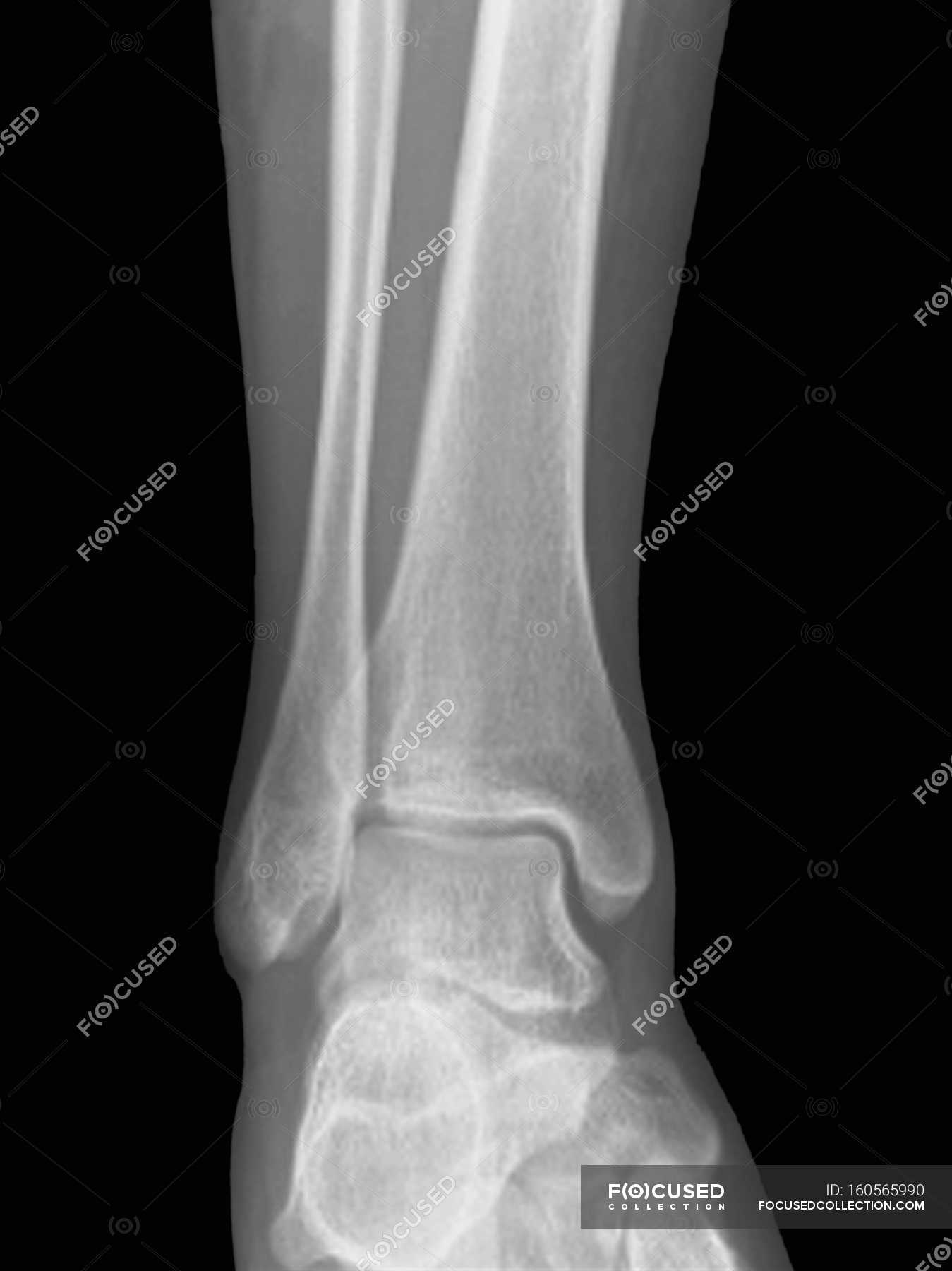 Normal ankle joint, frontal X-ray. — front view, human body - Stock