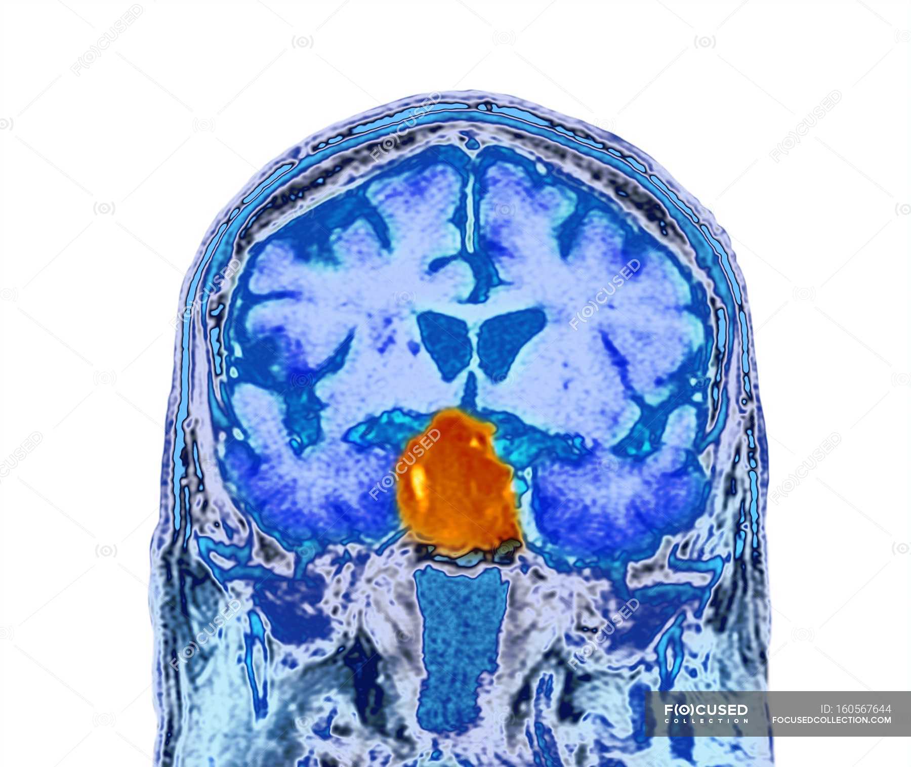 tumour-affecting-the-pituitary-gland-neoplasm-scan-stock-photo