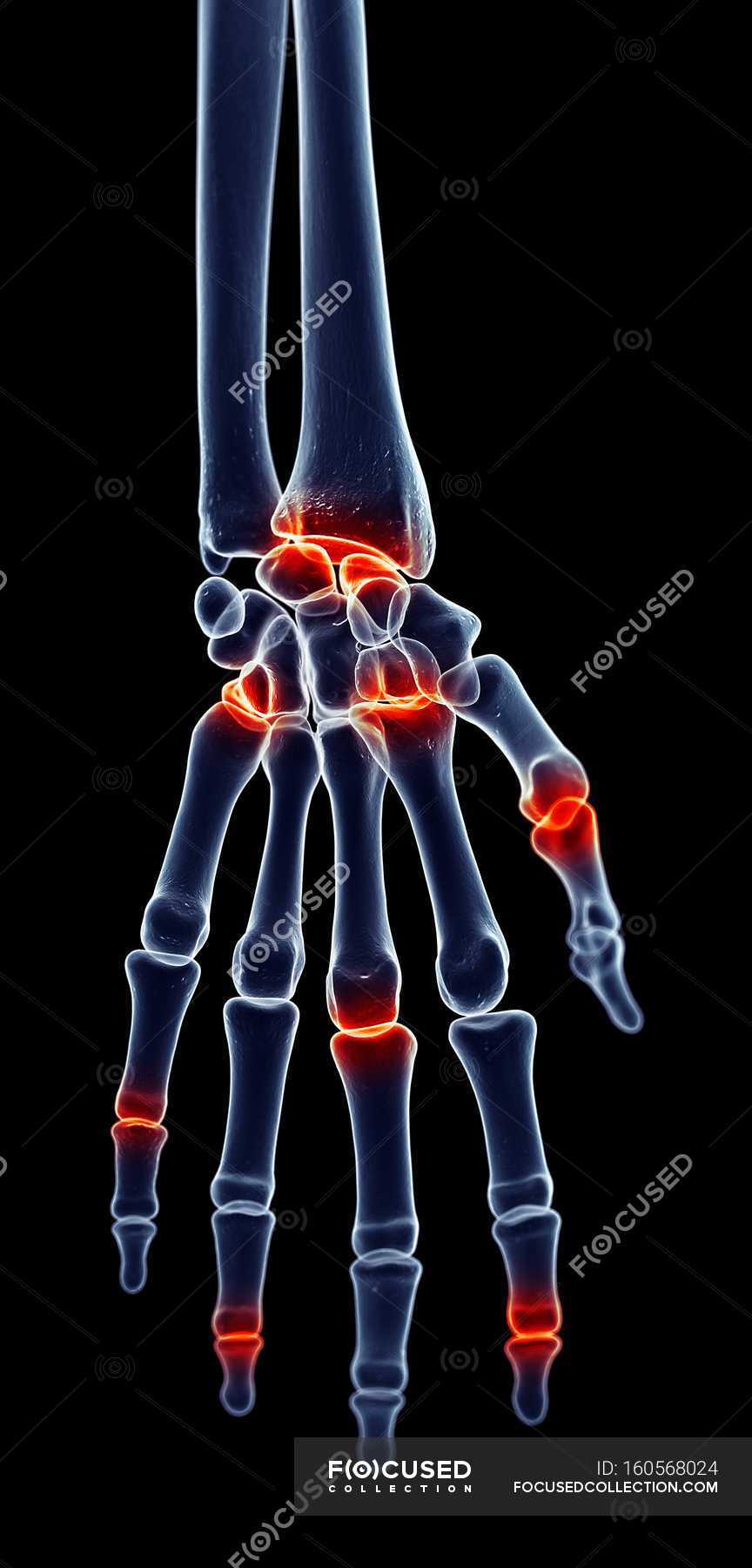 Pain localized in wrist and finger joints — details, anatomical Stock
