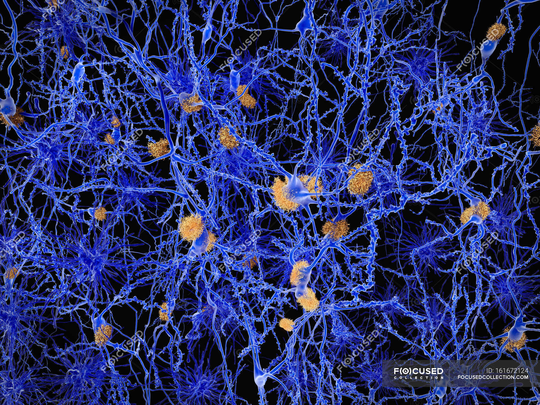 How To Say Amyloid