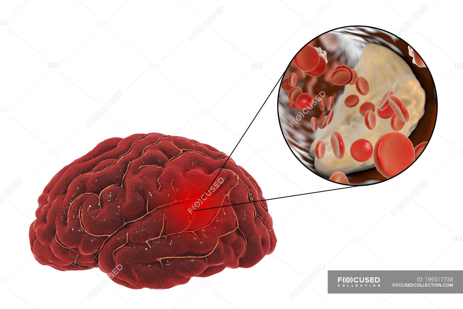 Illustration of arterial blockage causing stroke due to atherosclerosis ...