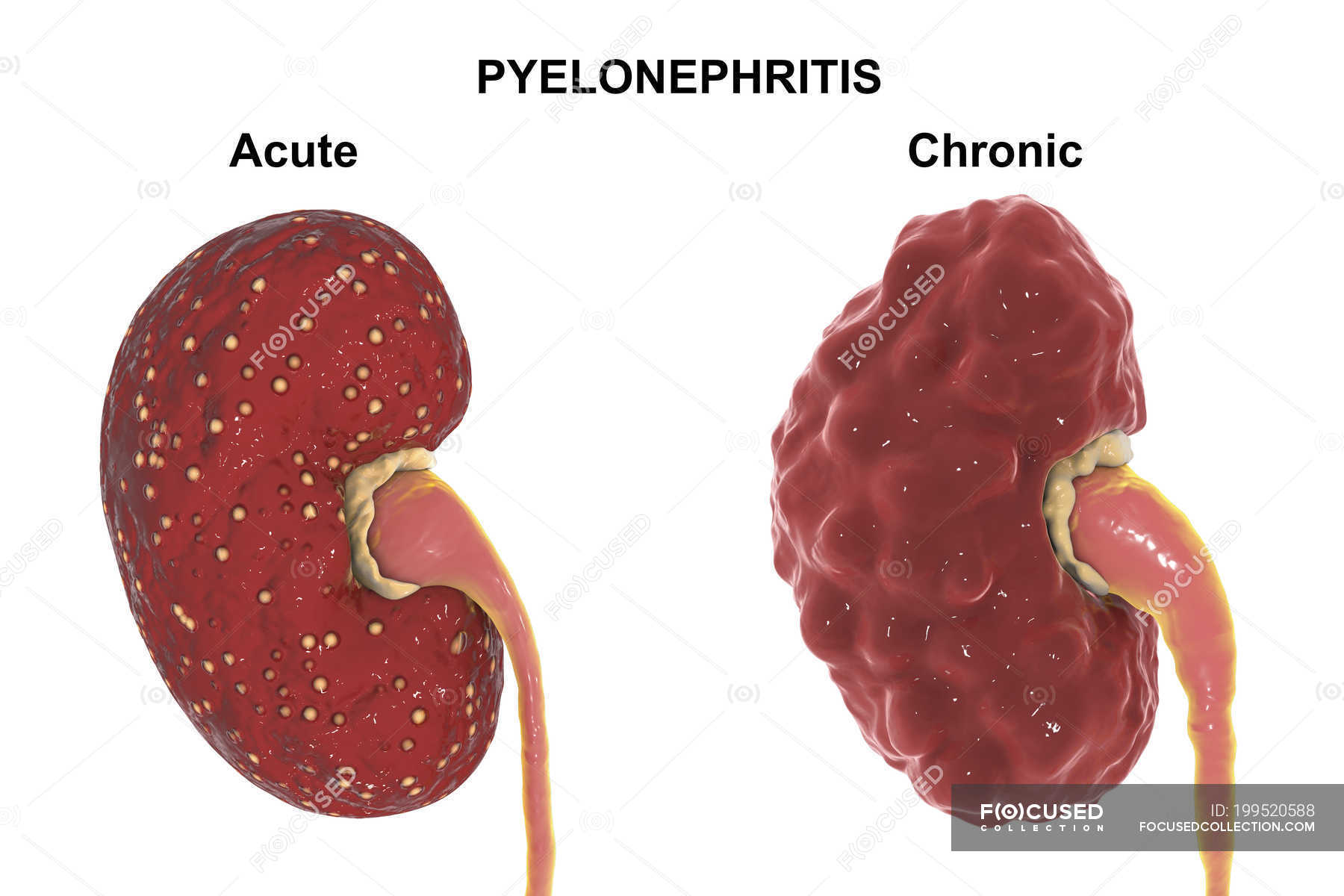 Comparison of gross anatomy of acute and chronic pyelonephritis