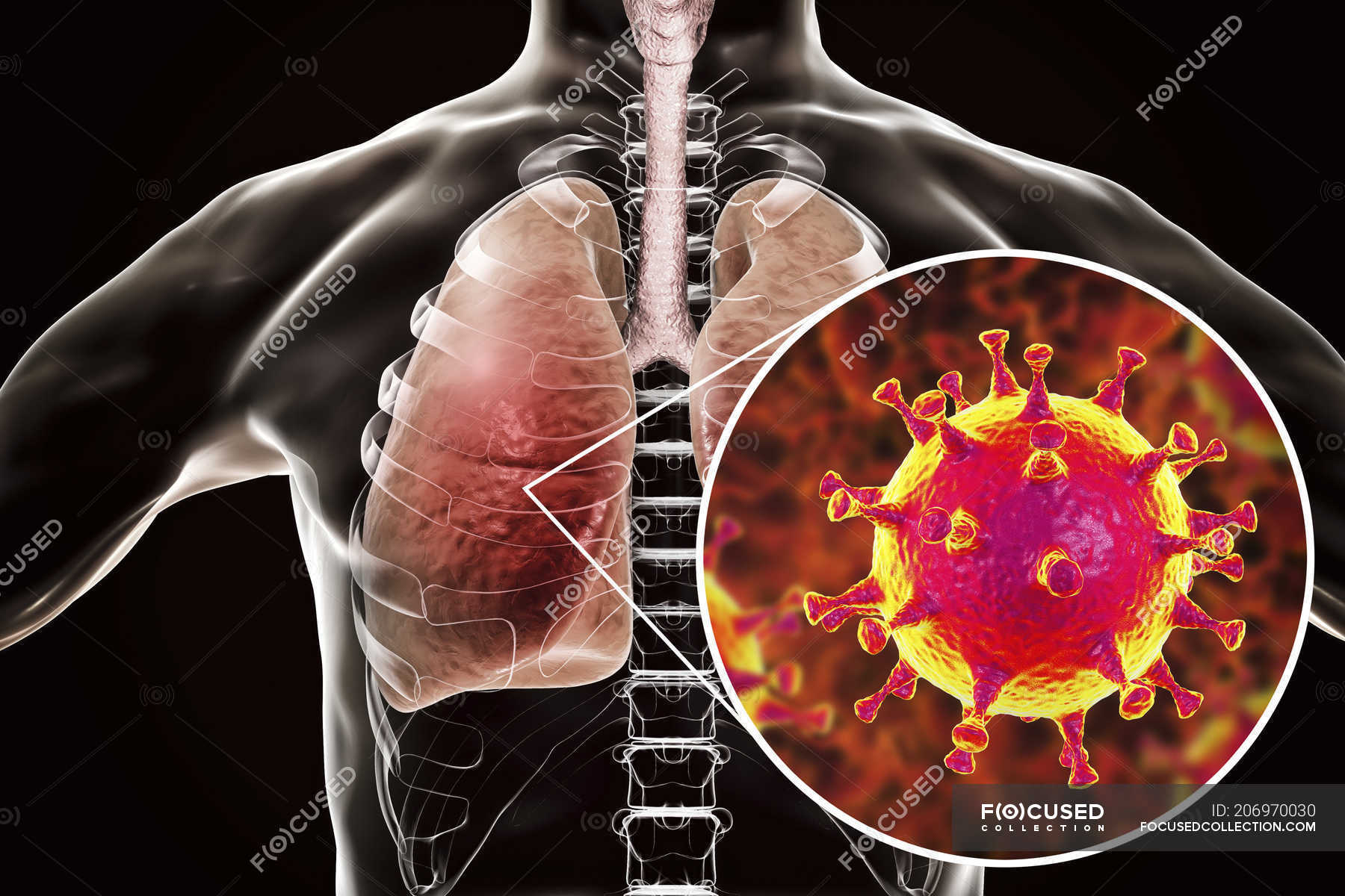 MERS virus infection of lungs, conceptual illustration. — disorder