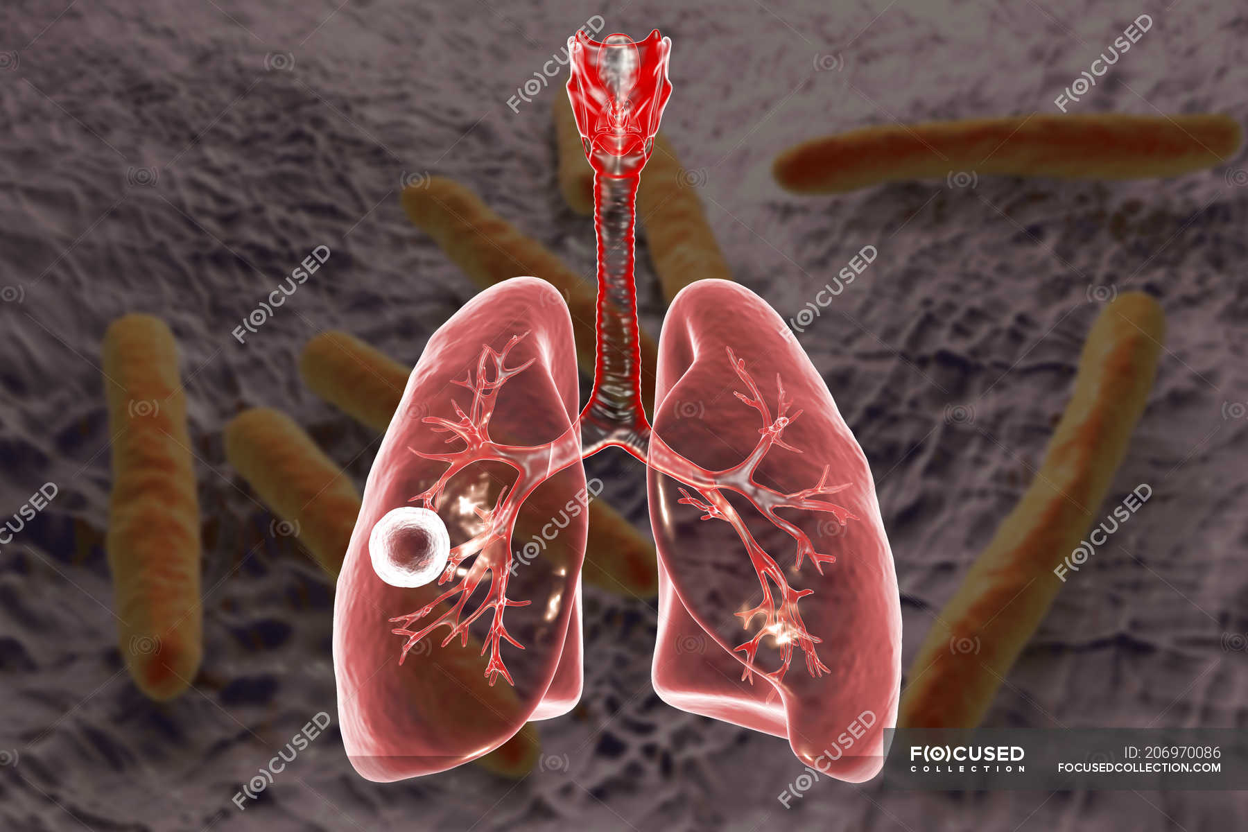 Cavidad fibrosa cavernosa de tuberculosis pulmonar en pulmón derecho