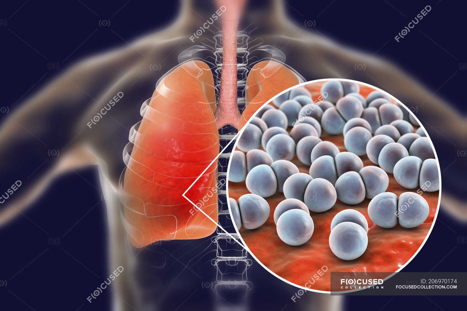 pneumonia-caused-by-streptococcus-pneumoniae-bacteria-conceptual