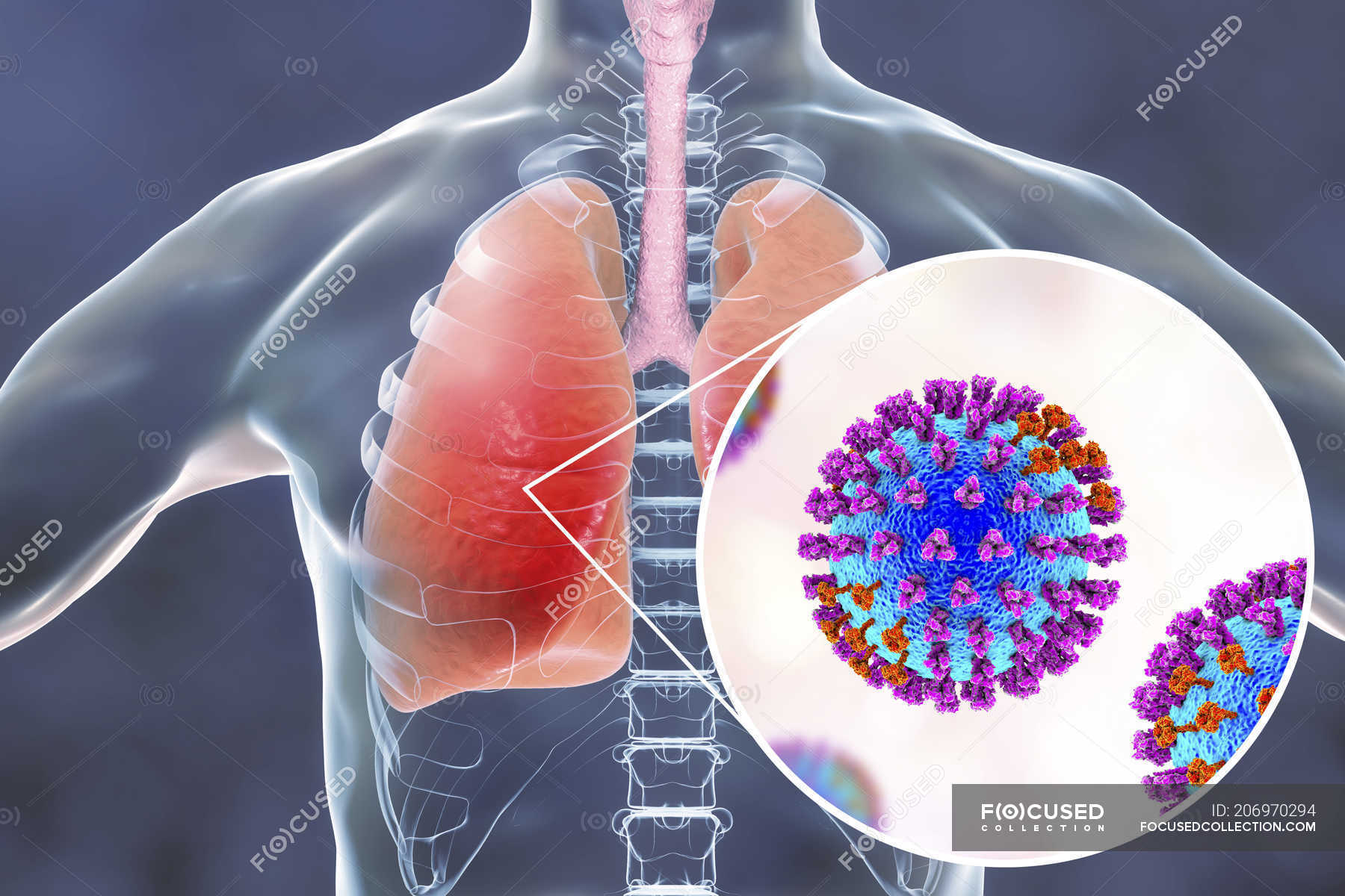 Human silhouette with lungs infected by pneumonia caused by flu ...