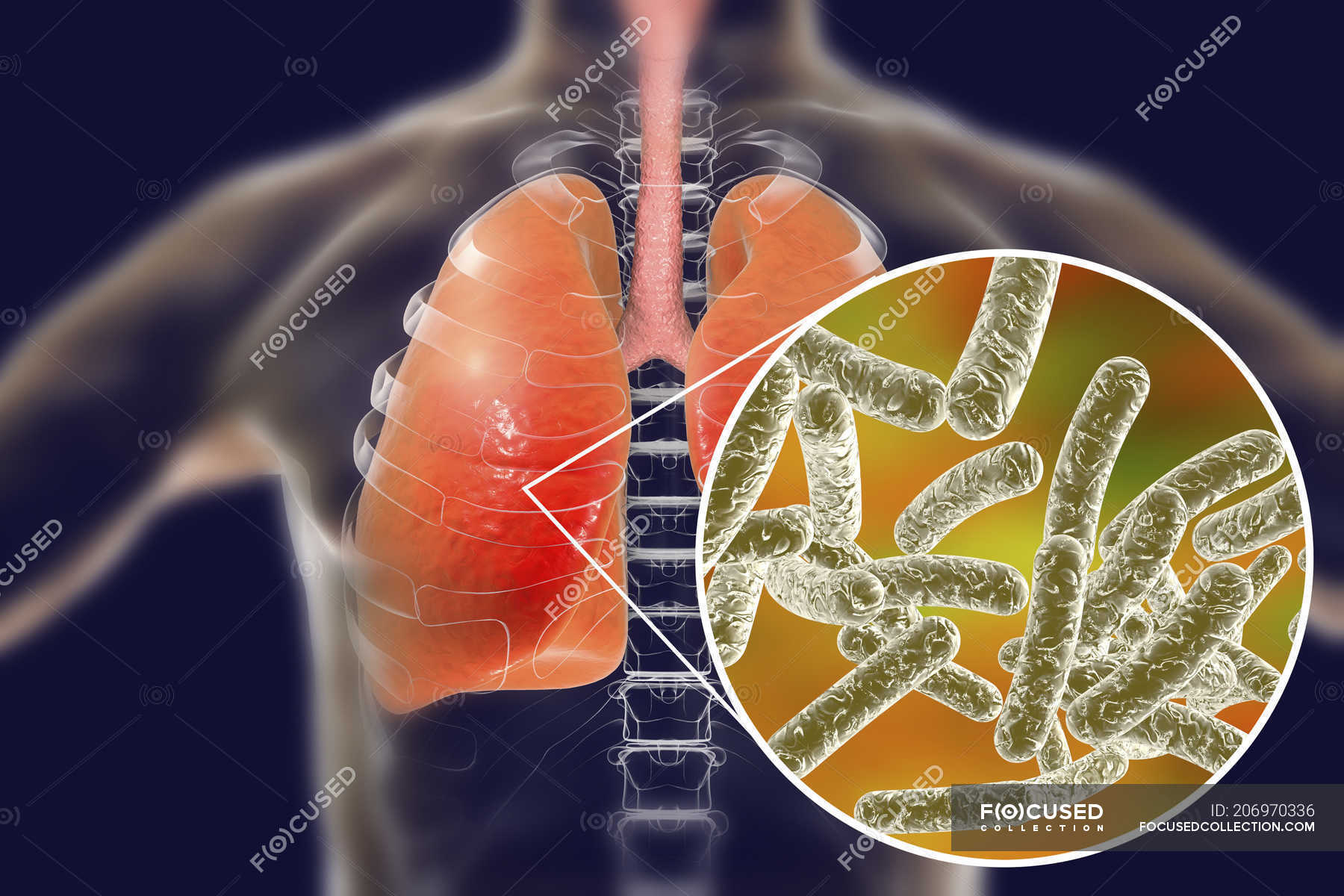 Lungs with Legionnaires disease and close-up of Legionella pneumophila ...