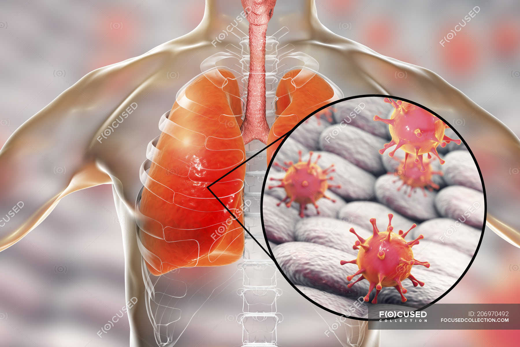 Human lungs with viral pneumonia and closeup of virions. — syndrome