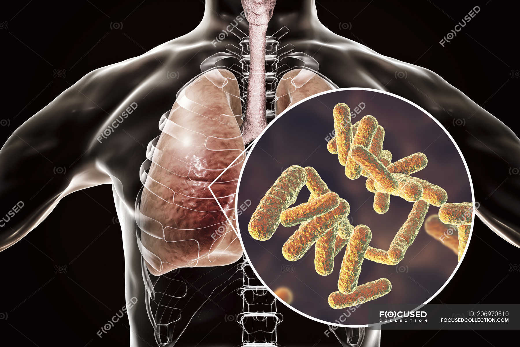 Human Lungs With Bacterial Pneumonia And Close Up Of Bacteria   Focused 206970510 Stock Photo Human Lungs Bacterial Pneumonia Close 