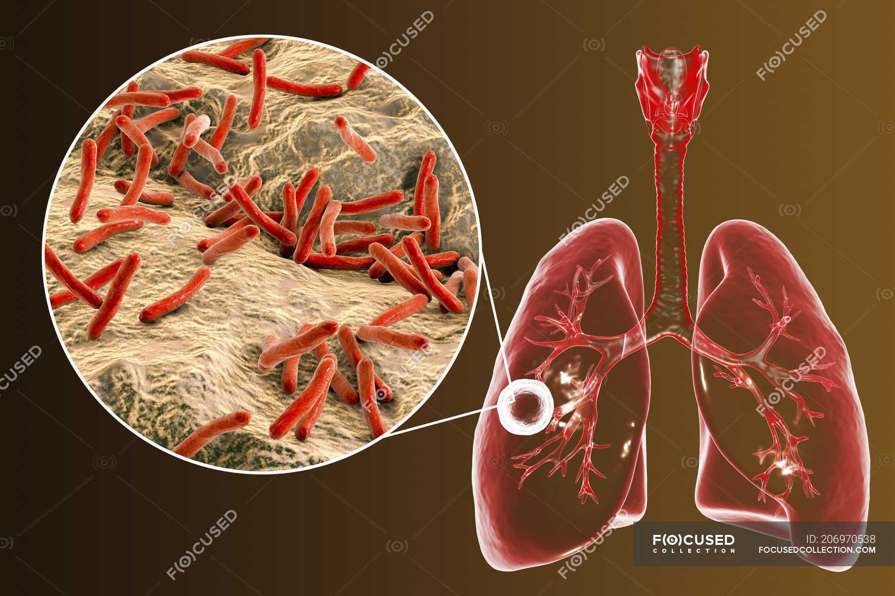 Fibrous-cavernous pulmonary tuberculosis and close-up of Mycobacterium ...