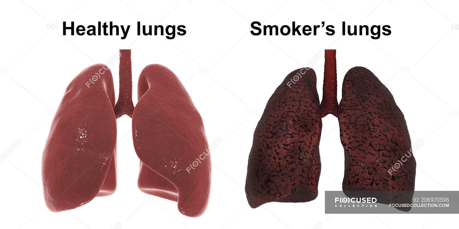 Smoker's Lungs, Illustration And Light Micrograph Stock Image F022/6857 ...