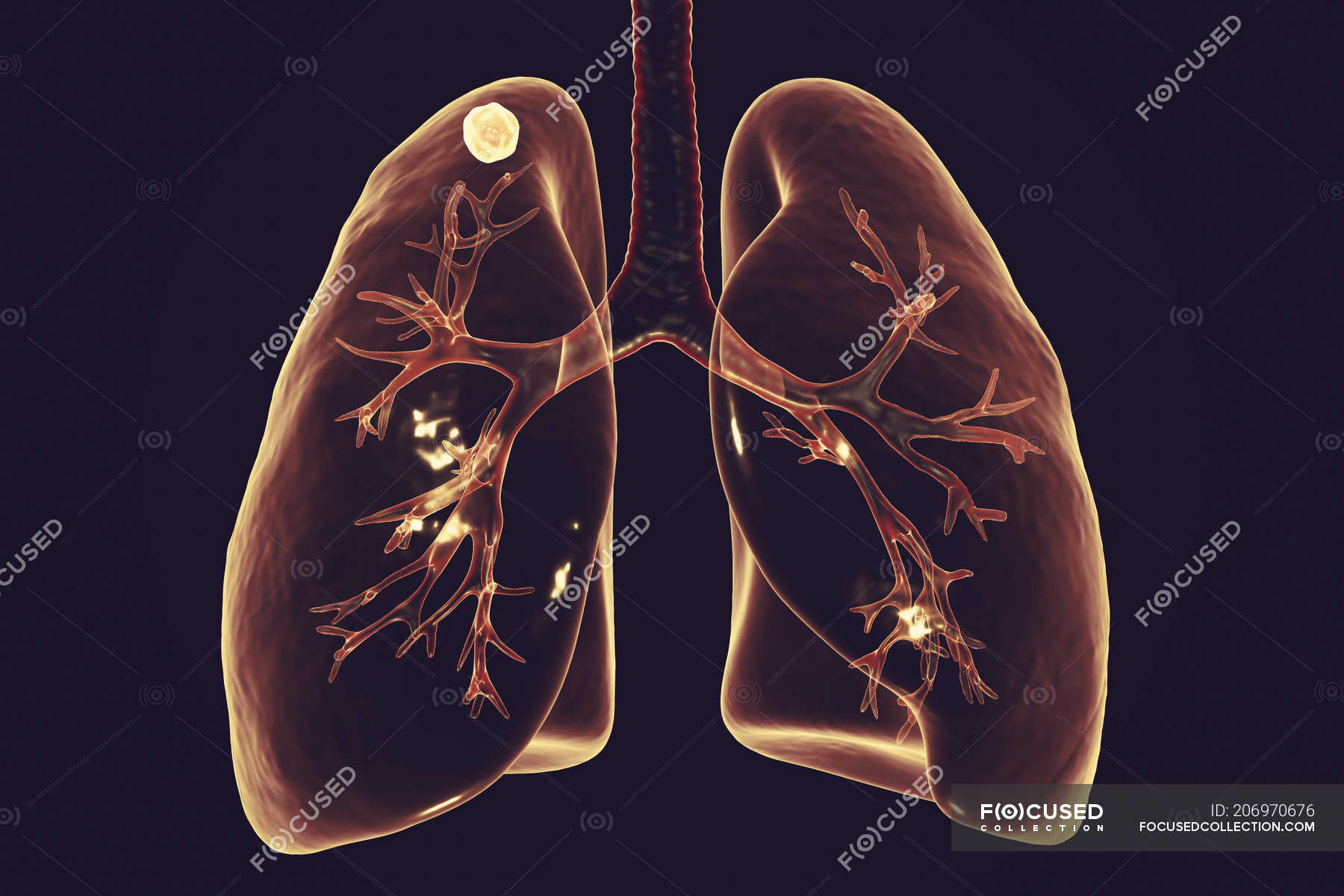 Digital Illustration Of Solid Node In Right Lung Near Lung Apex While digital-illustration-of-solid-node-in-right-lung-near-lung-apex-while