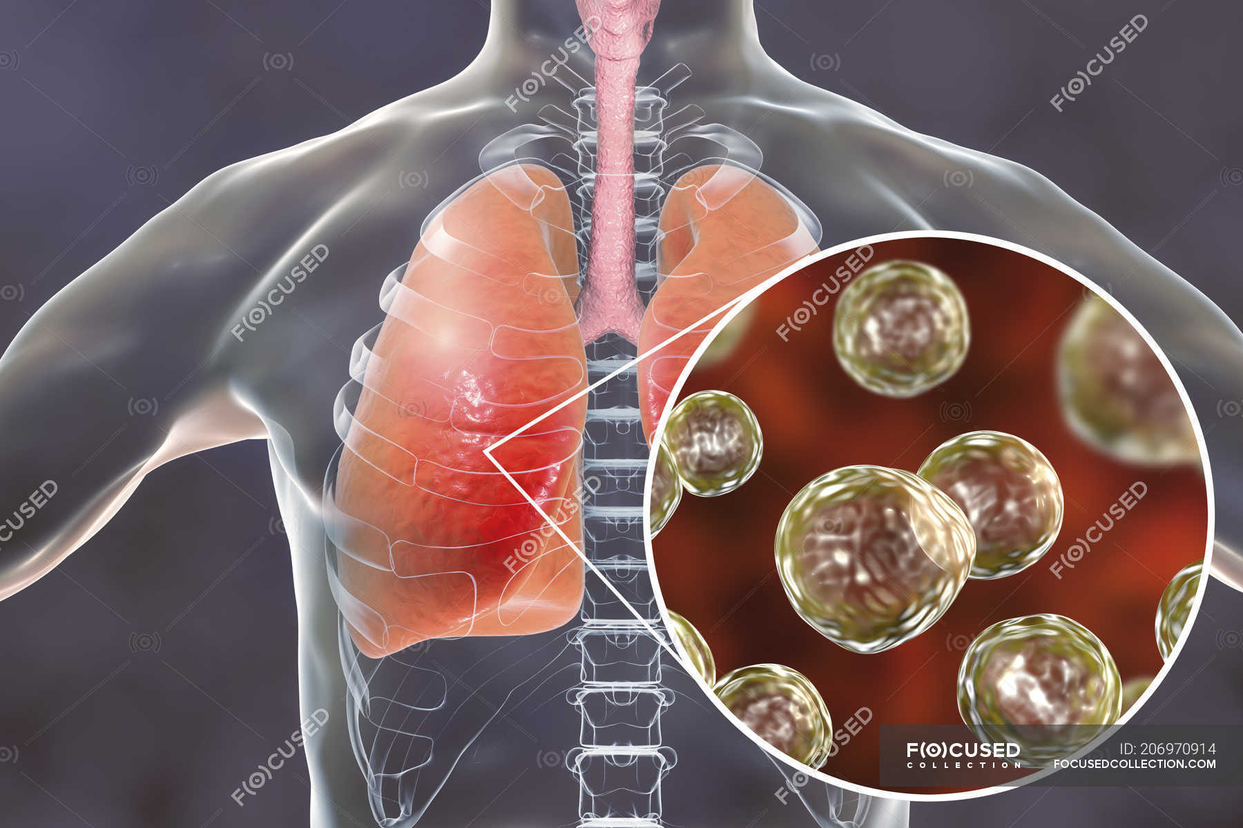 Human silhouette with infected lungs with Pulmonary blastomycosis and ...