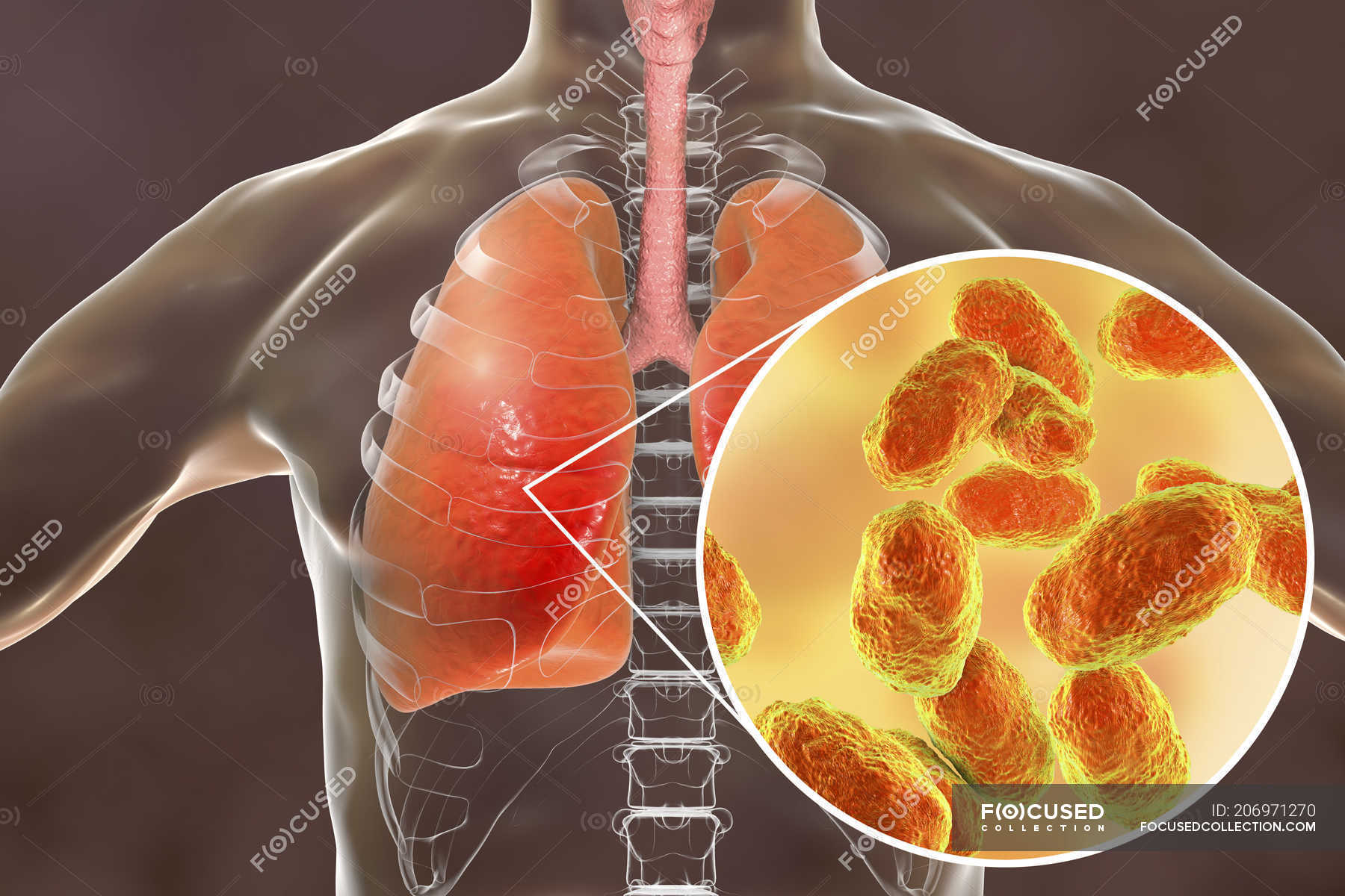 Lungs pneumonia and closeup of Haemophilus influenzae bacteria