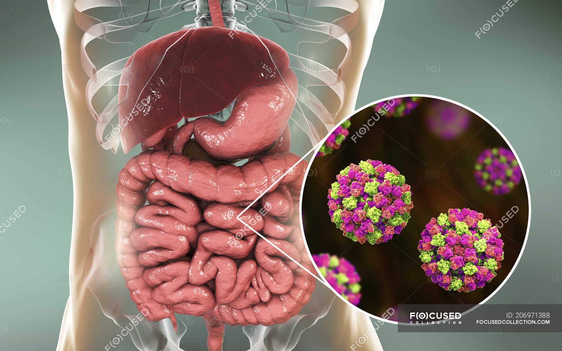 norovirus-infection-in-small-intestine-digital-illustration