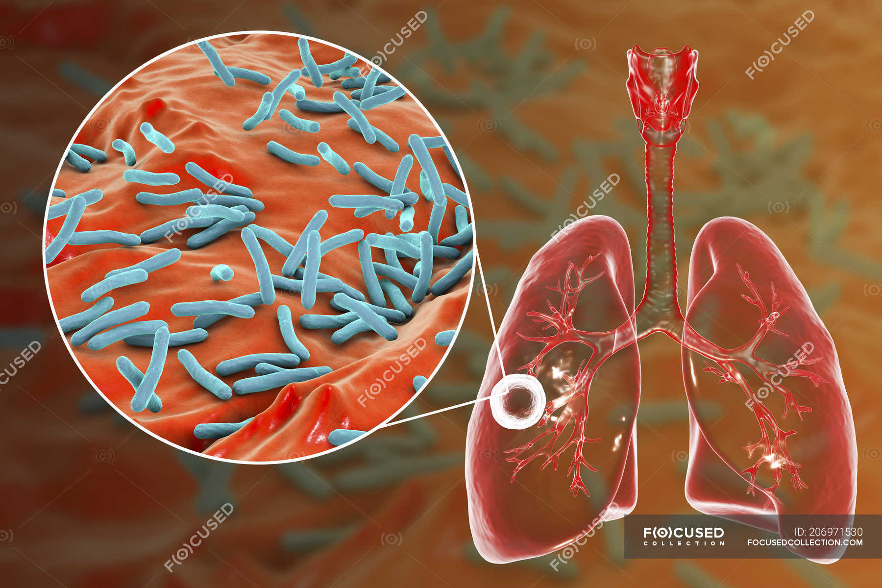 Tuberculosis pulmonar fibrocavernosa y primer plano de la bacteria