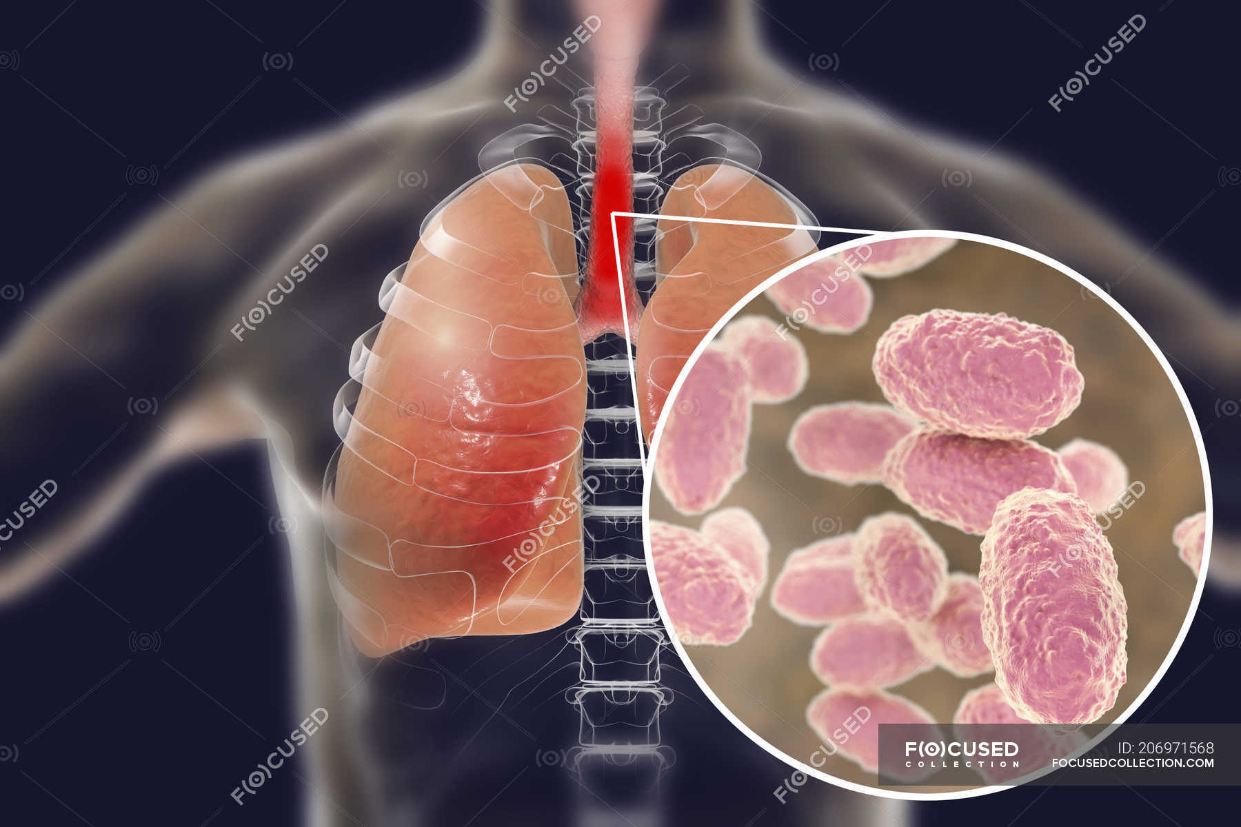 Whooping cough contagious infectious lungs disease and closeup of