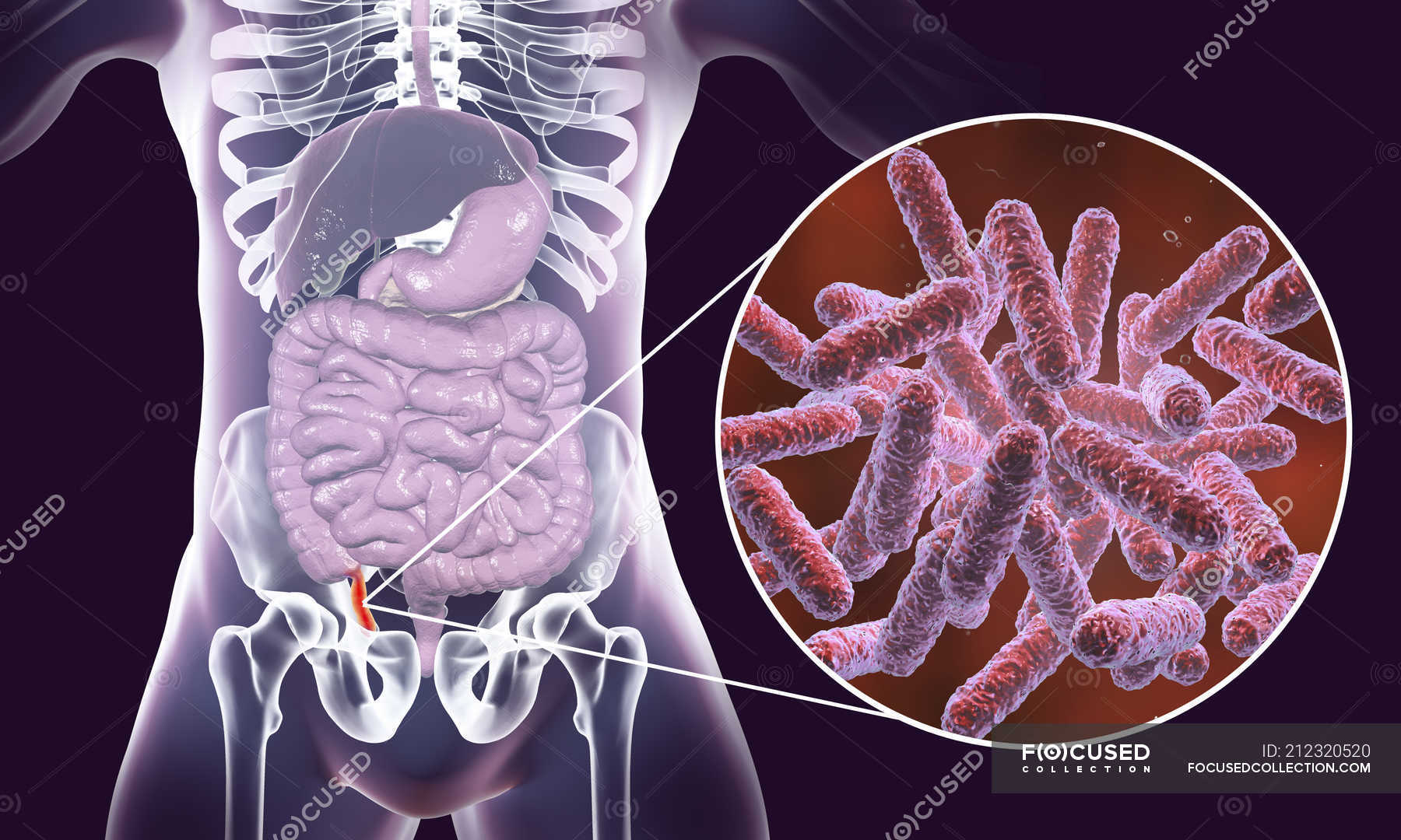 Illustration Of Red And Inflamed Human Appendix And Close Up Of   Focused 212320520 Stock Photo Illustration Red Inflamed Human Appendix 