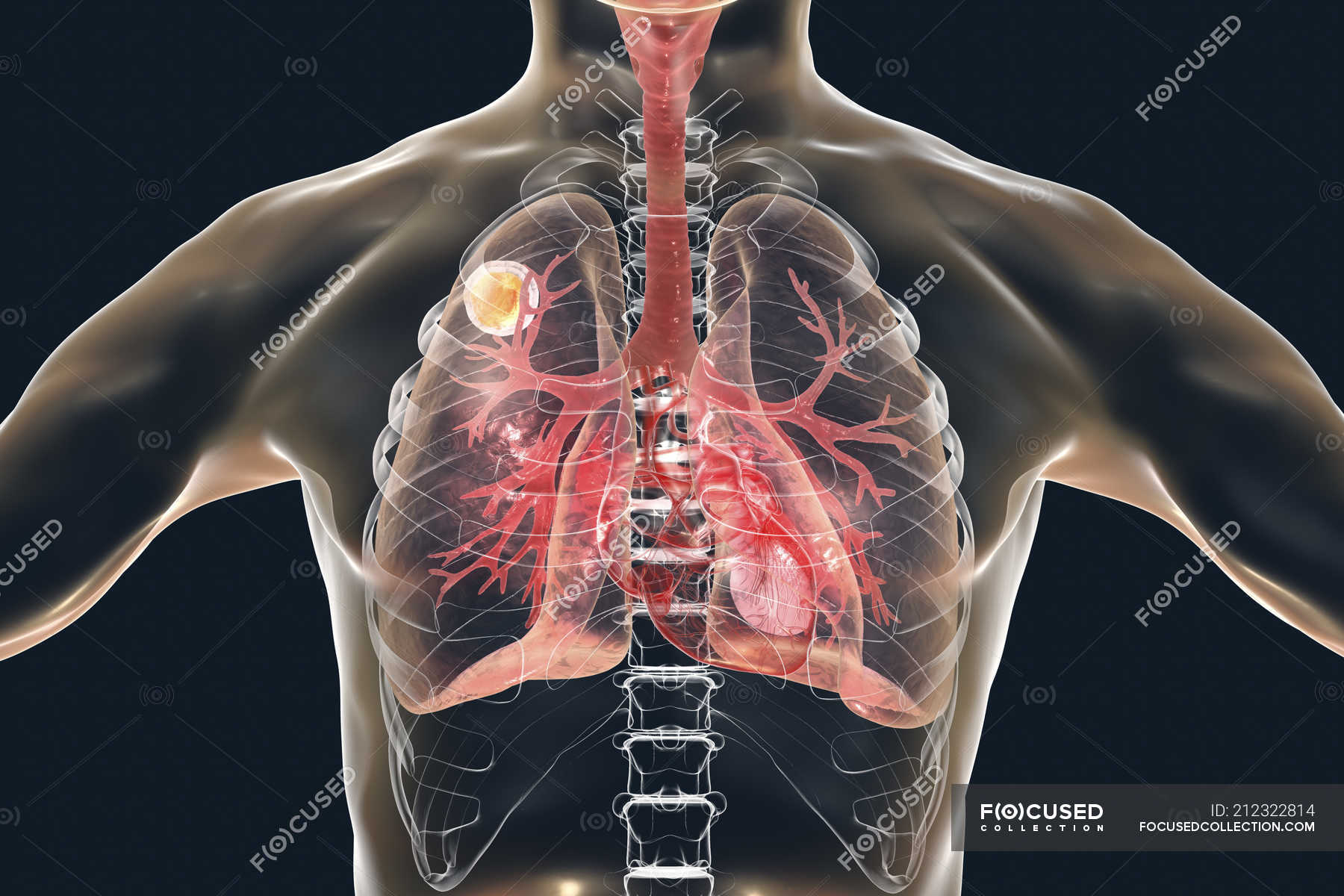 Aspergilloma disease of lungs, digital illustration. — illness, fungus ...