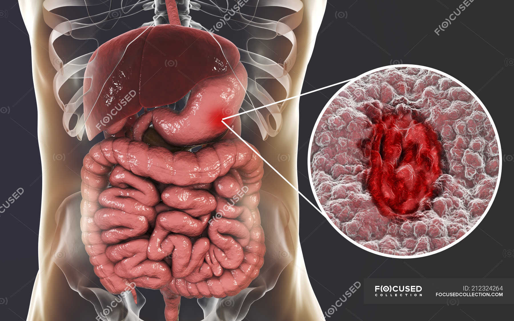 Human silhouette with gastric ulcer of stomach, illustration