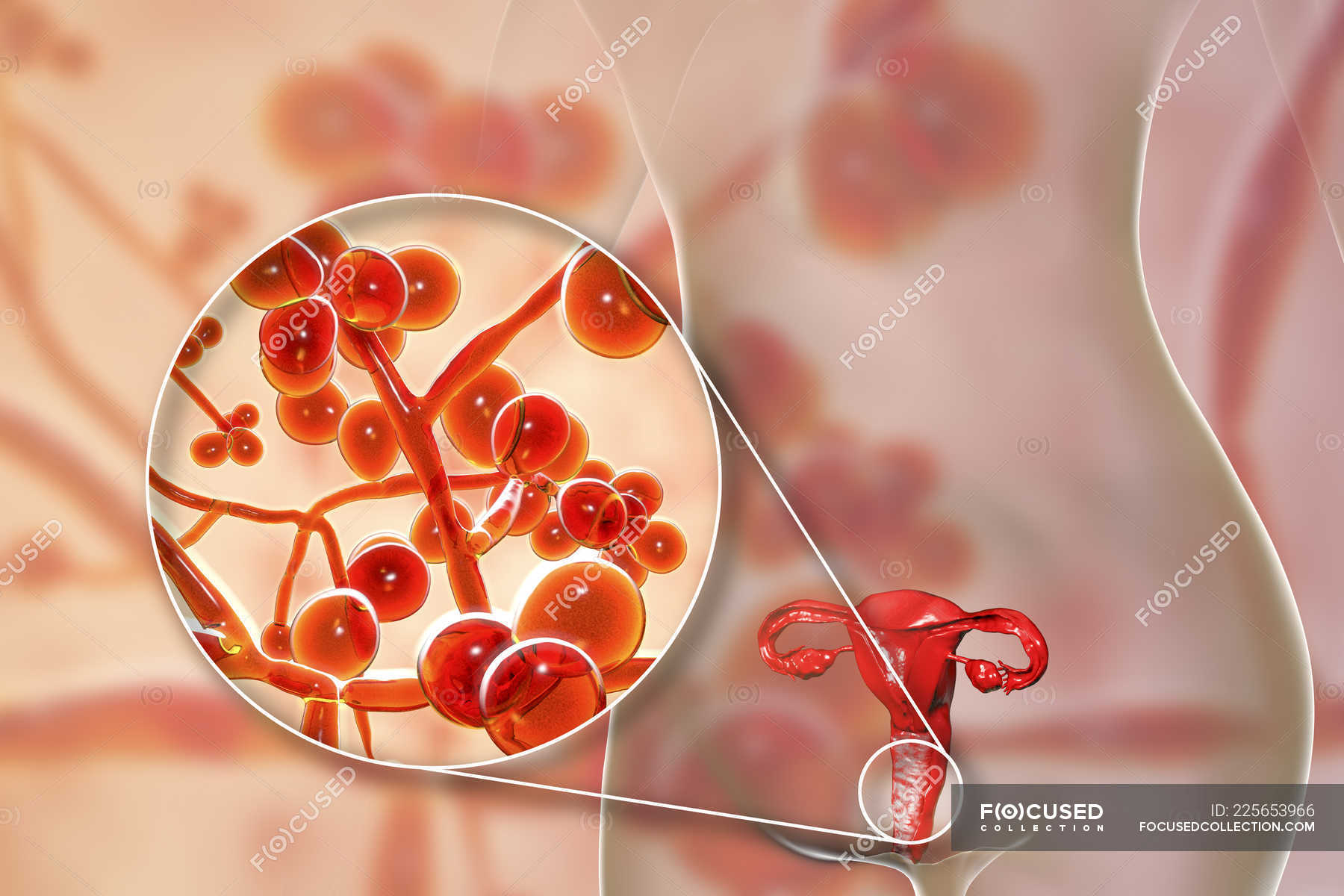 Digital Illustration Showing Vaginitis Caused By Candida Auris Fungus And Close Up Of Yeast 2462