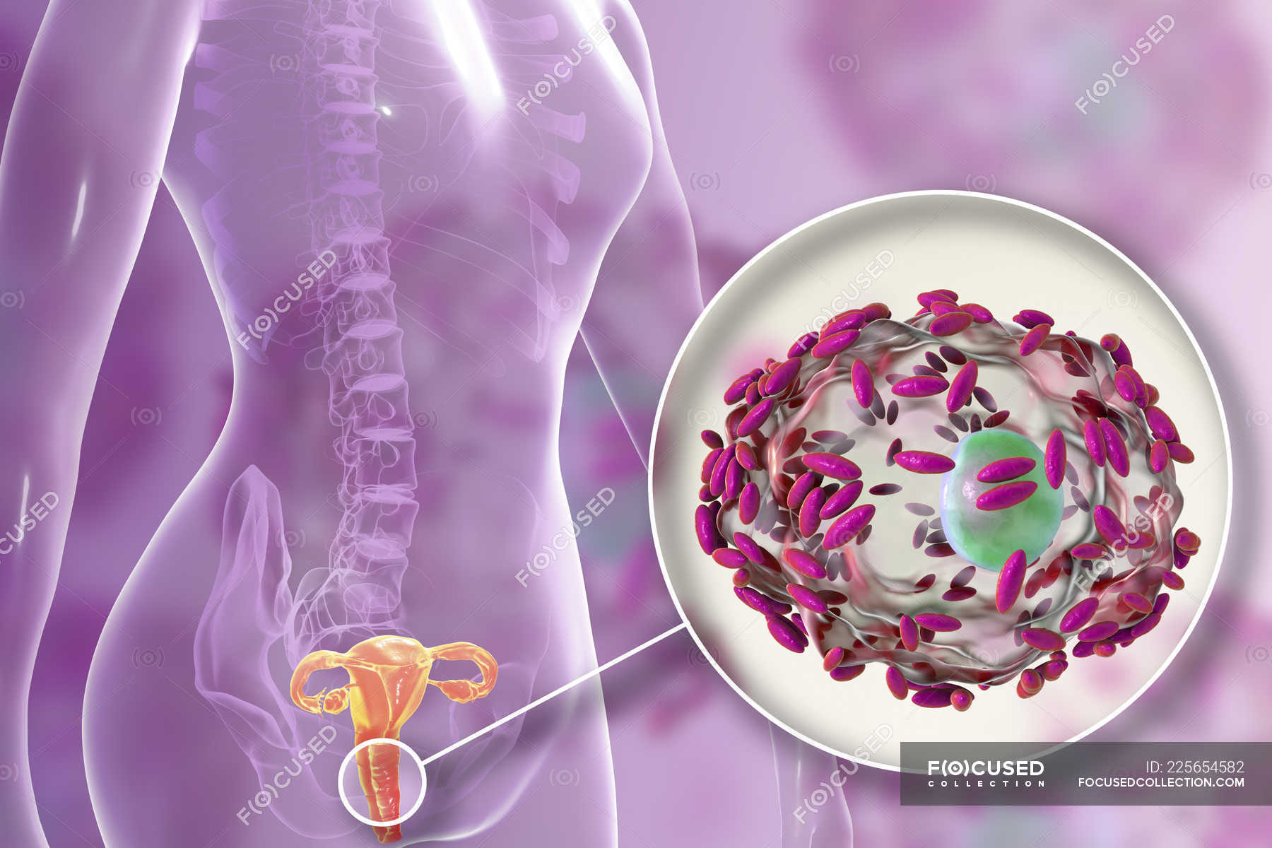 Female Reproductive System And Gardnerella Vaginalis Bacteria Attached To Vaginal Epithelial