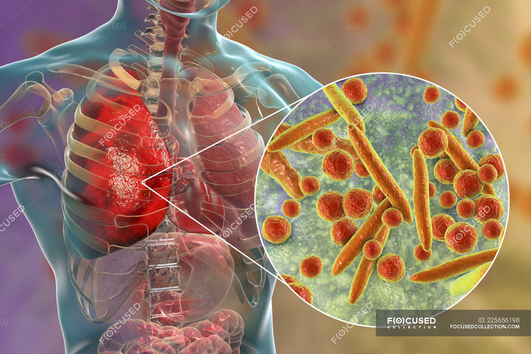 pneumonia-caused-by-mycoplasma-pneumoniae-bacteria-conceptual-digital