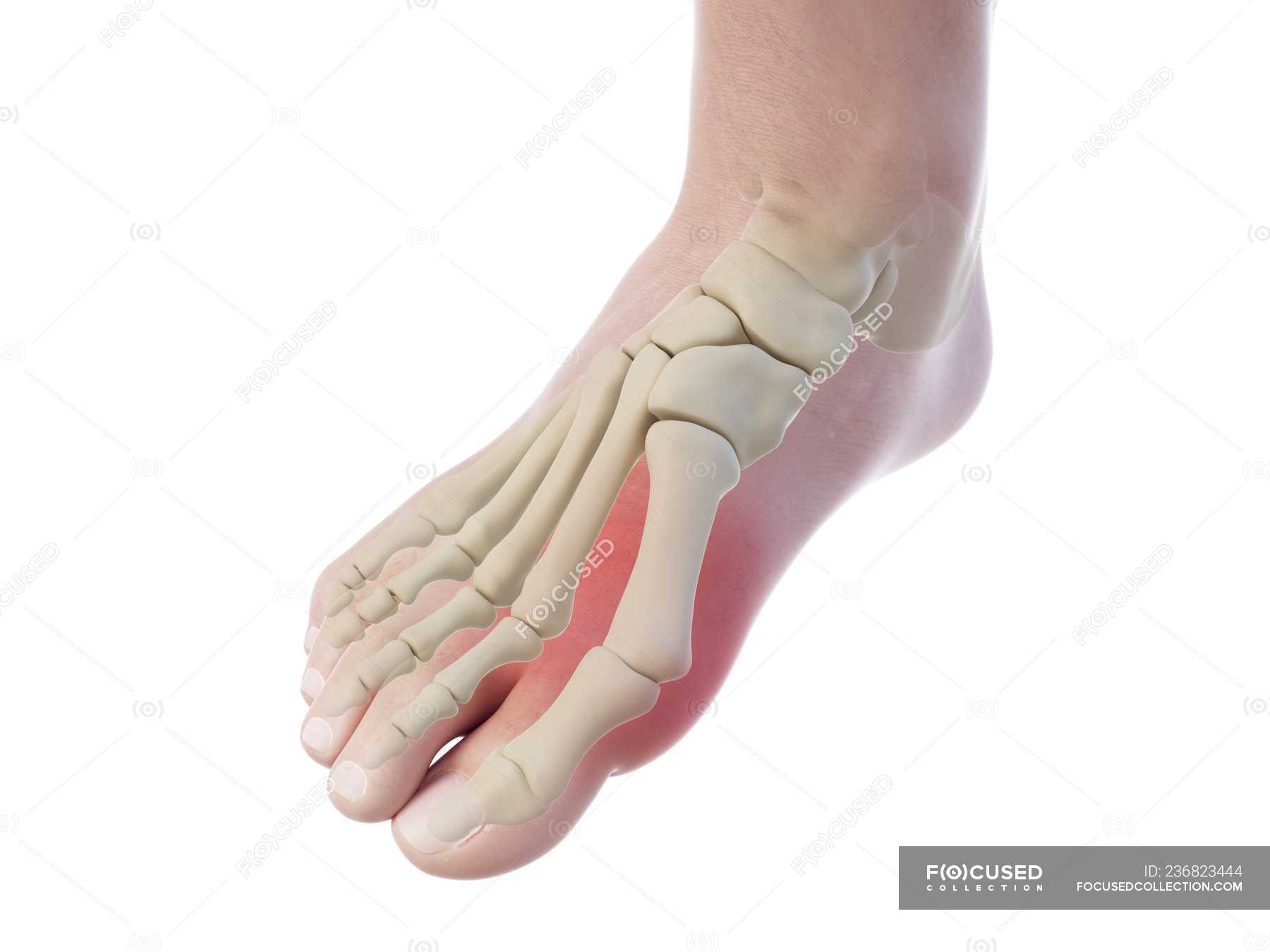 Illustration of bunion in human skeleton on white background. — painful ...