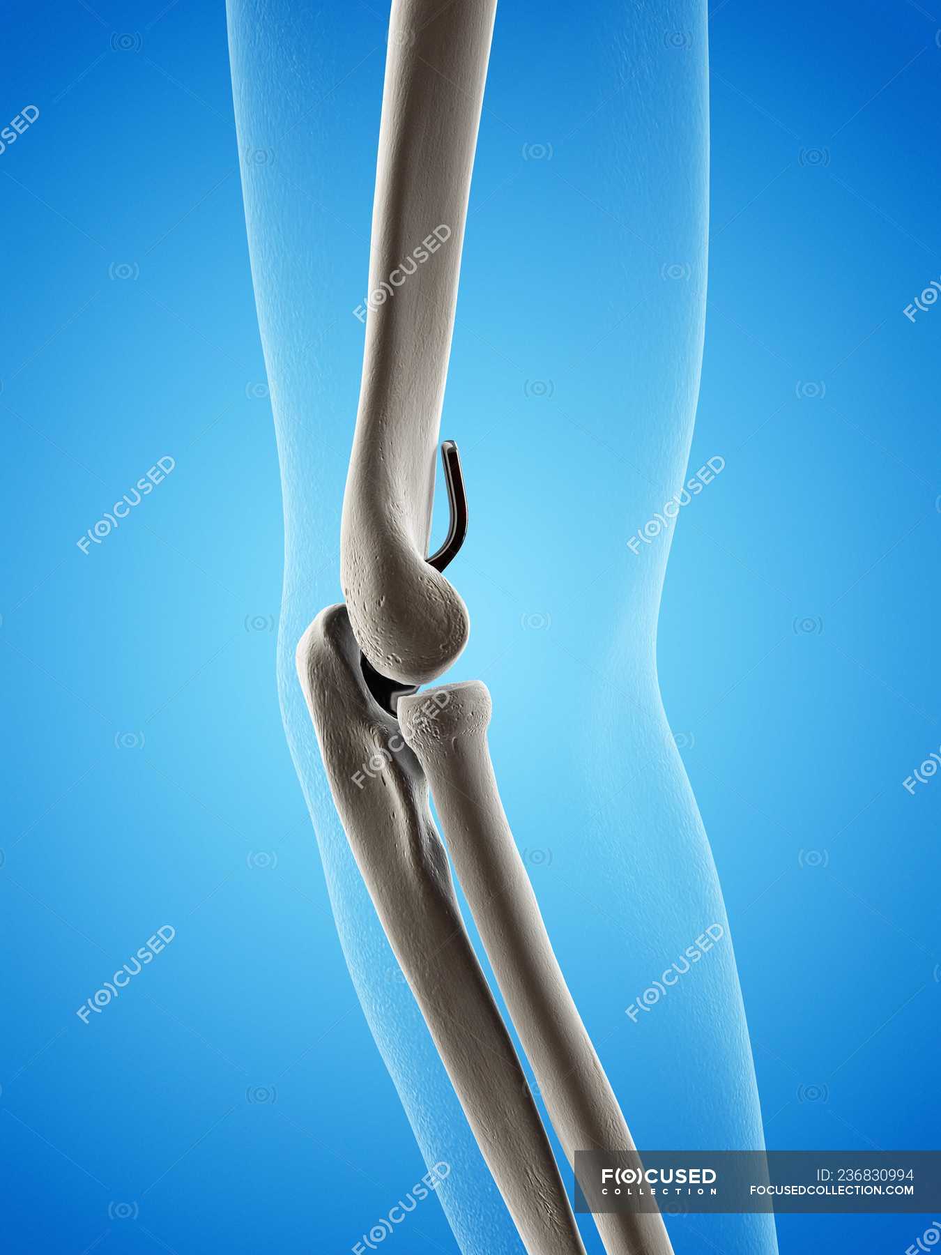 Illustration of elbow replacement prosthesis on blue background ...