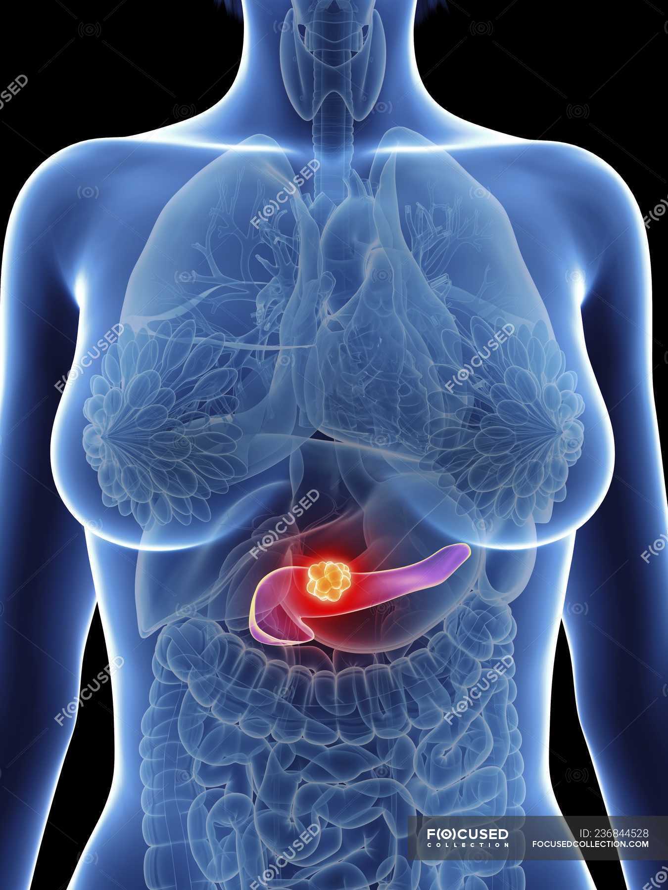 Illustration of female silhouette with highlighted pancreas cancer