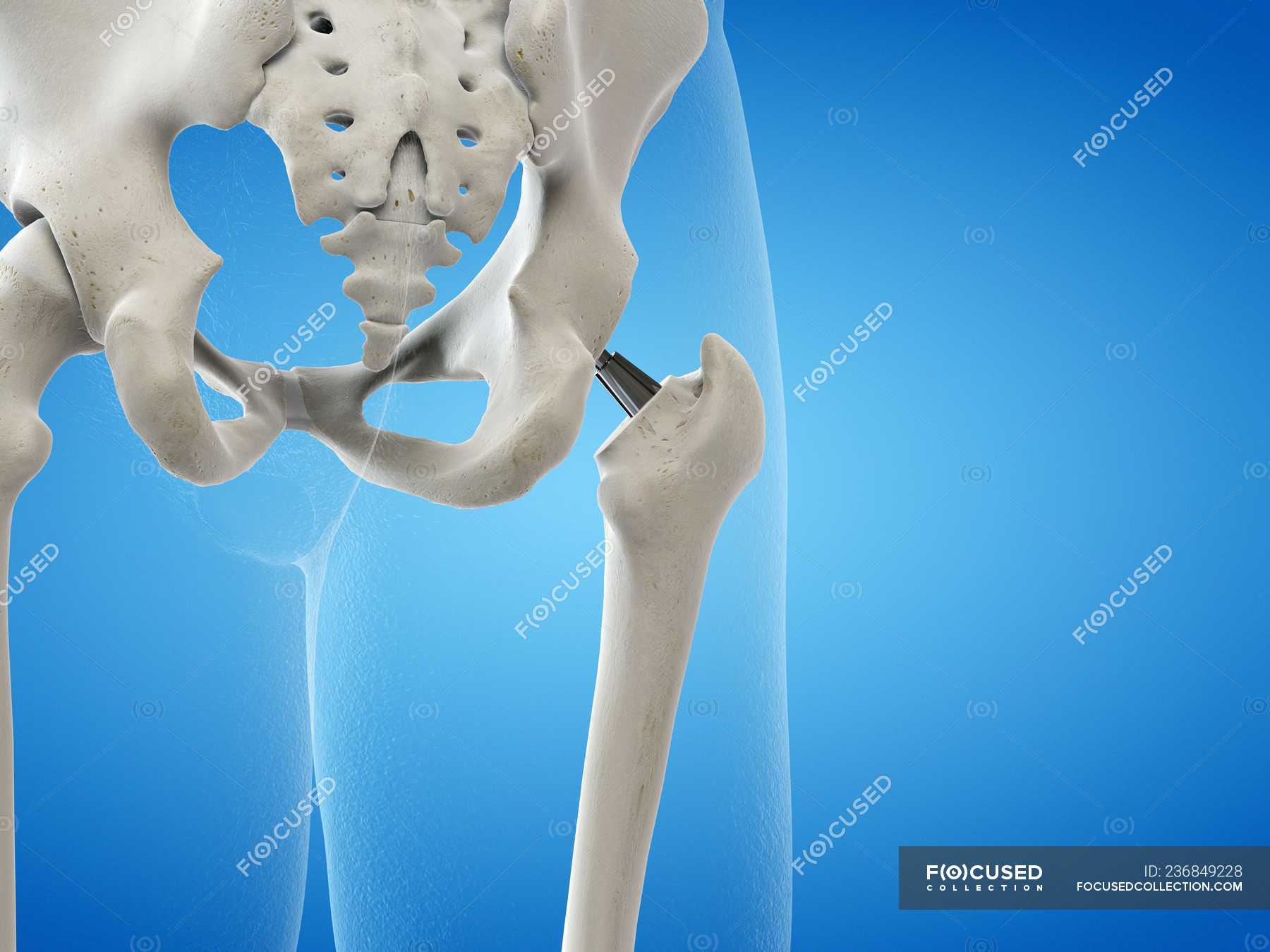 Illustration of hip replacement metal implant on blue background ...