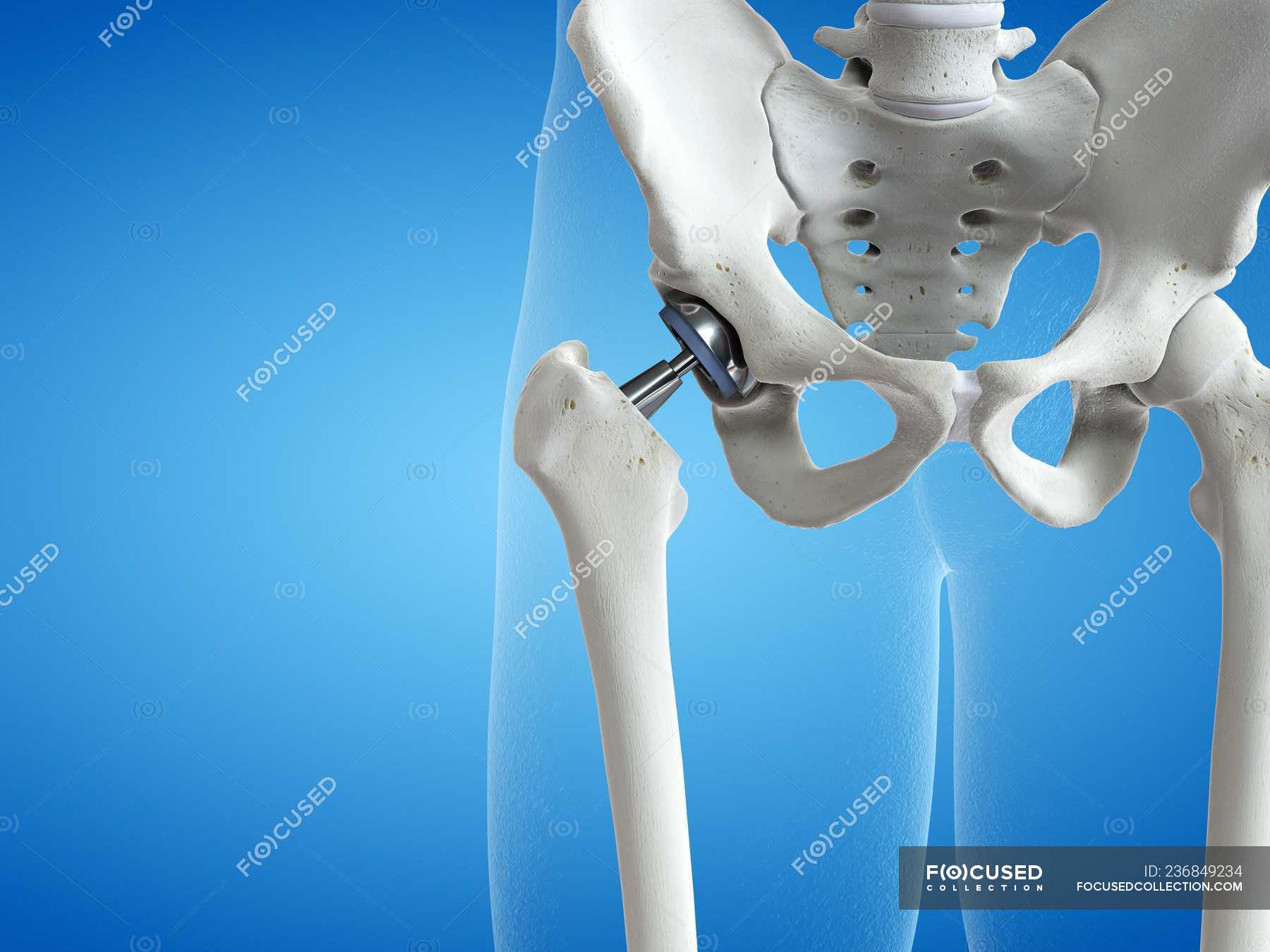 Illustration of hip replacement metal implant on blue background ...