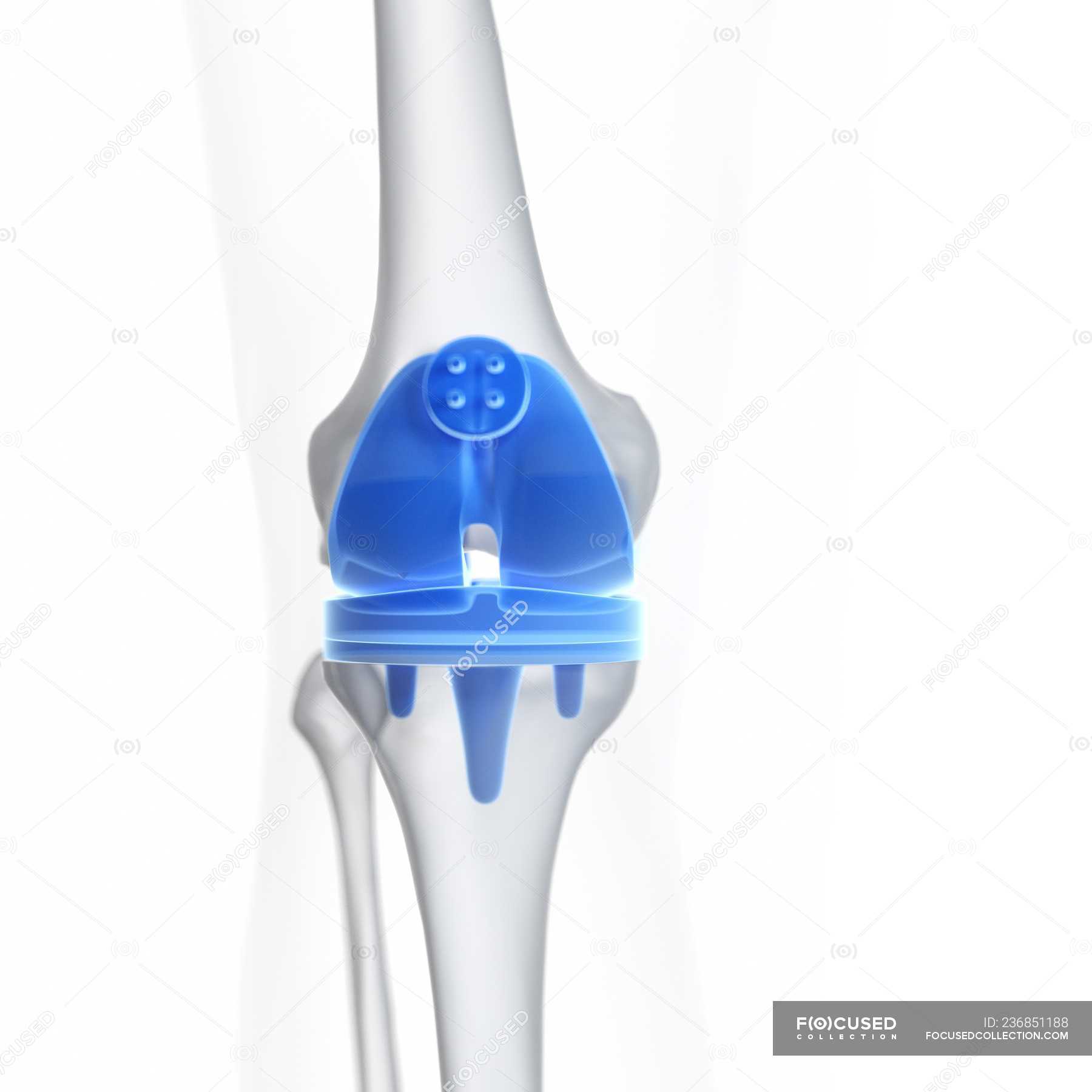 Illustration of knee replacement implant on white background ...