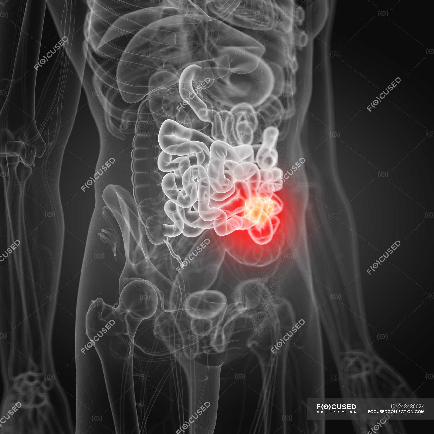 Illustration du cancer de l