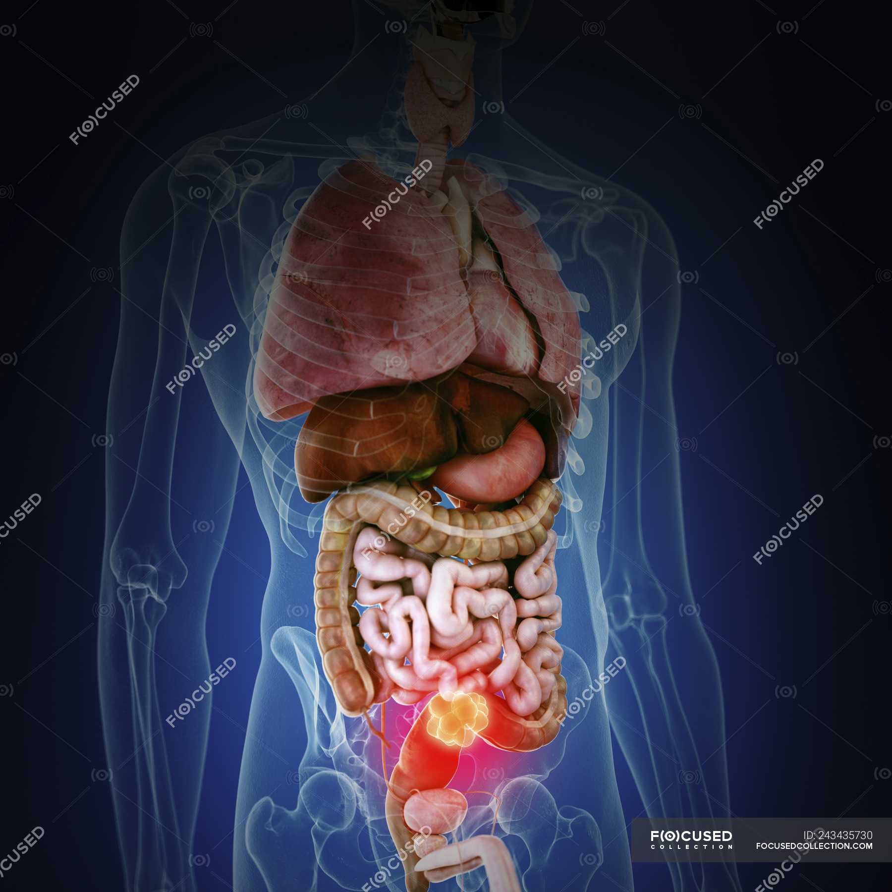 Illustration of colon cancer in human body silhouette. — Digitally ...