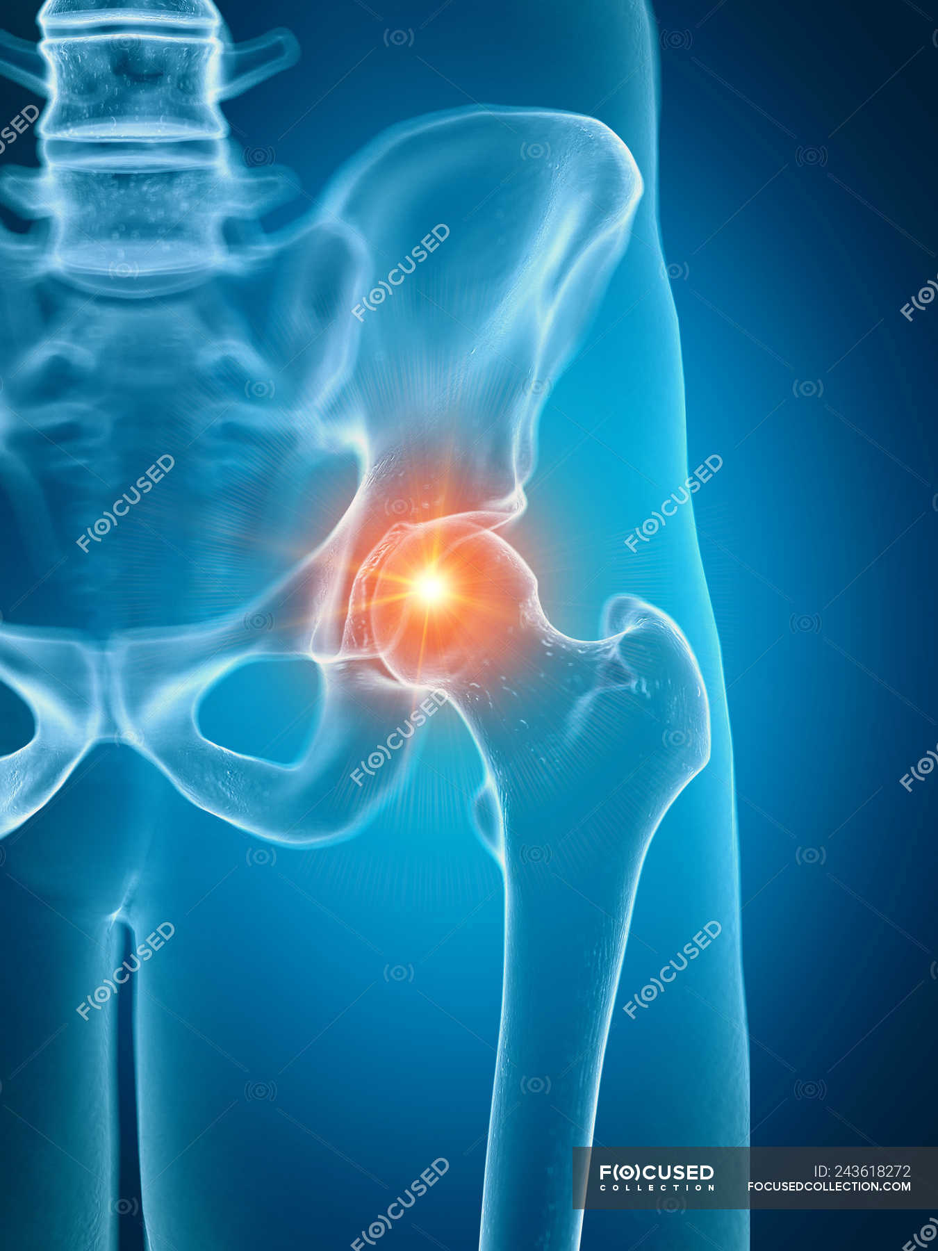 Illustration of painful hip joint in human skeleton part. — symphysis ...