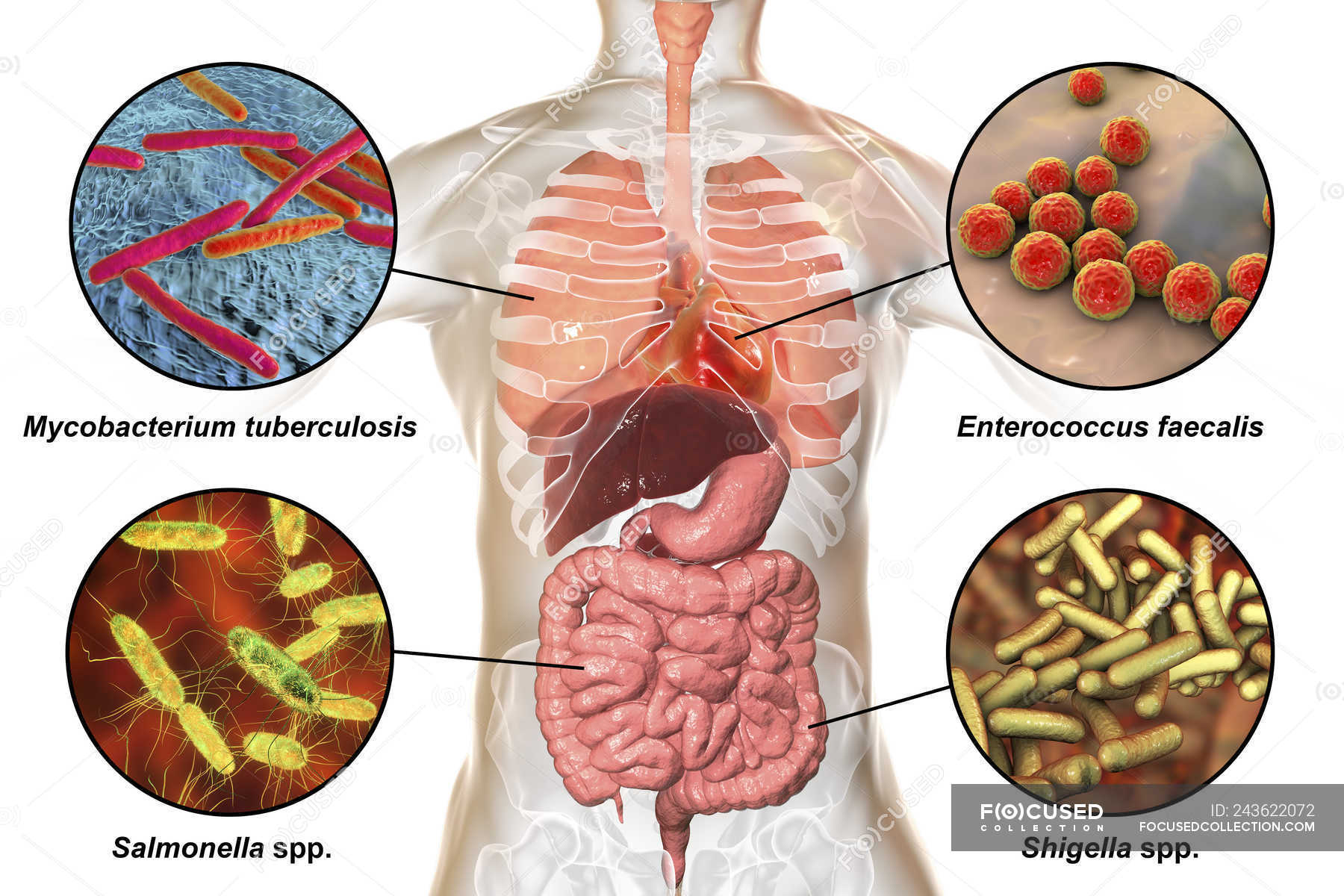 Ilustración Digital Que Muestra Bacterias Causantes De Infecciones Del