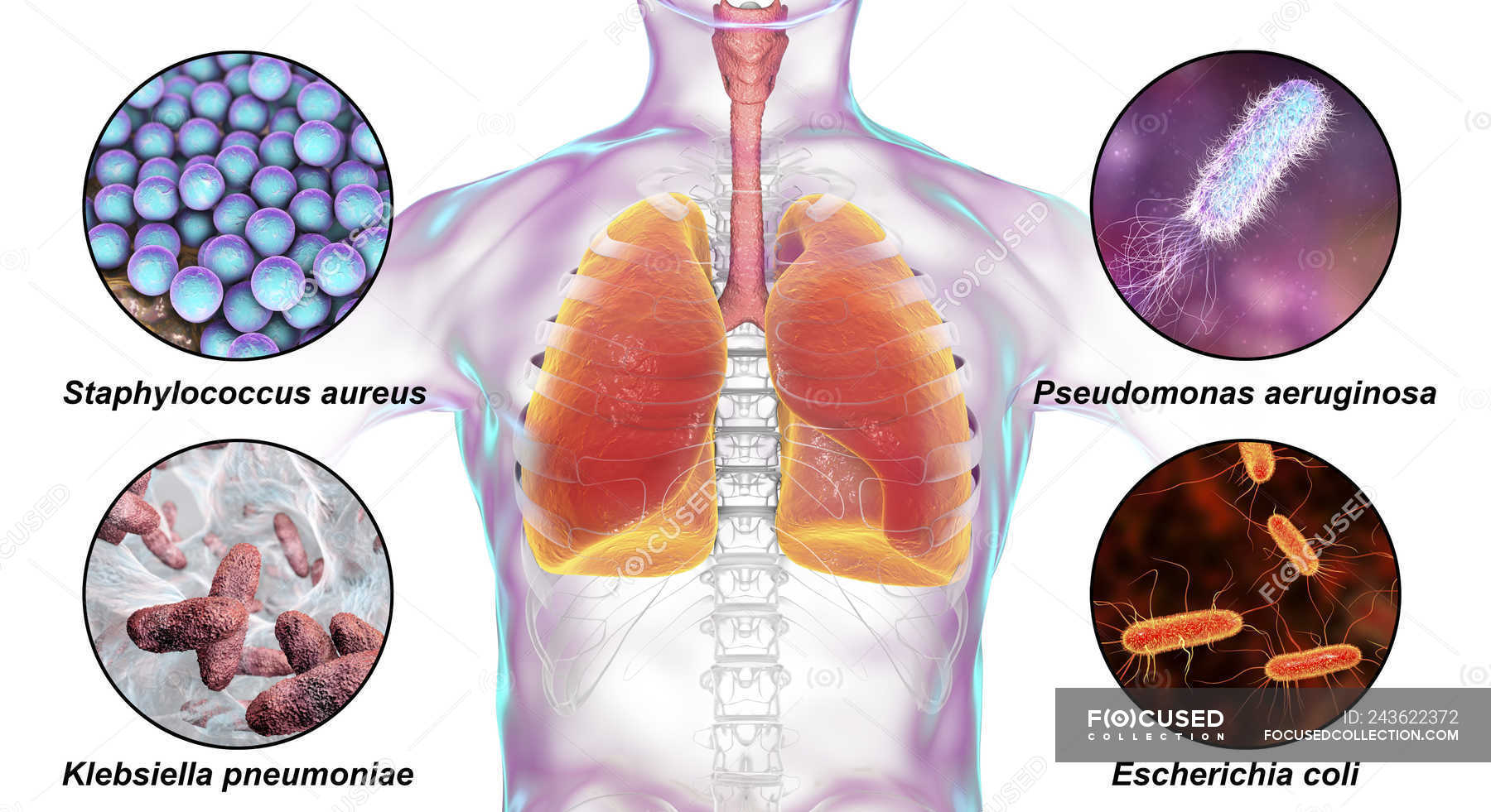 пересевы золотистый стафилококк. золотистый стафилококк в легких. золотистый стафилококк в легких. патогенный стафилококк ауреус. золотистый стафилококк в легких.
