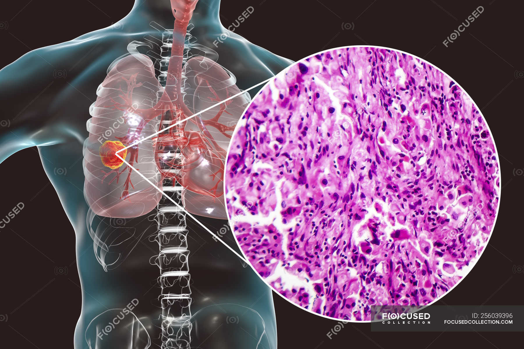 Lung cancer, digital illustration and light micrograph of cancerous ...