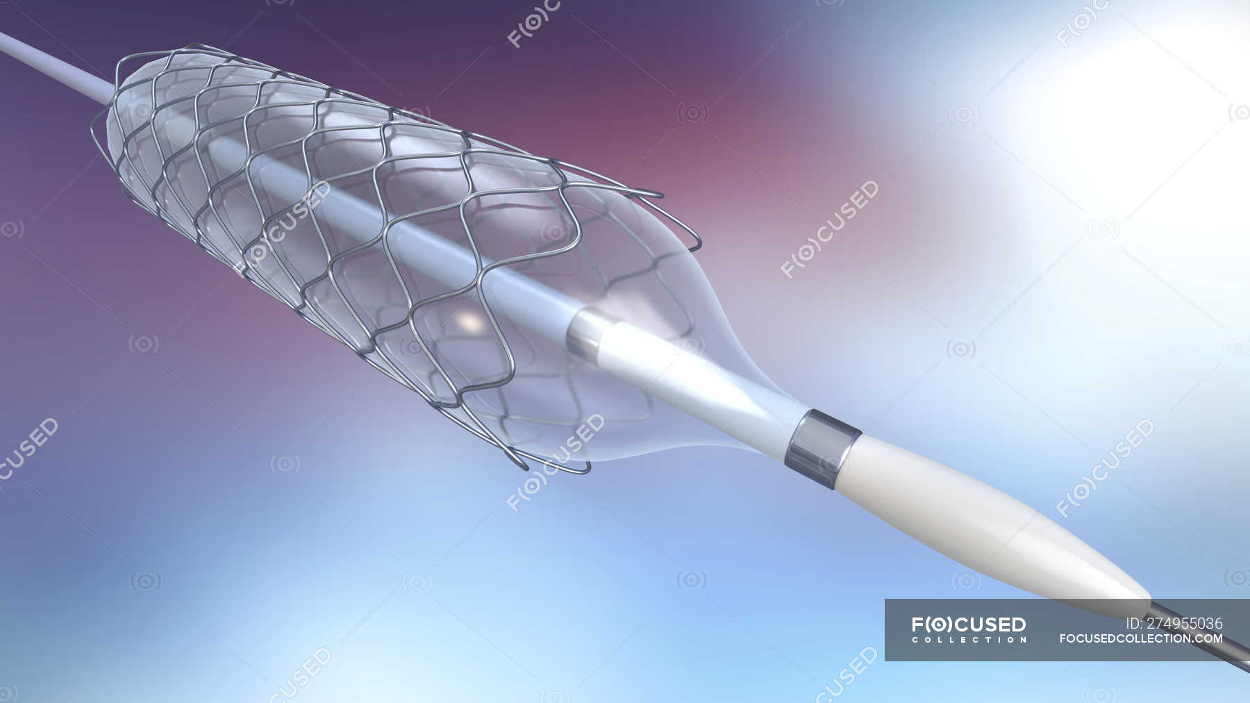 Stent and balloon catheter for implantation into blood vessel, digital illustration. — surgery