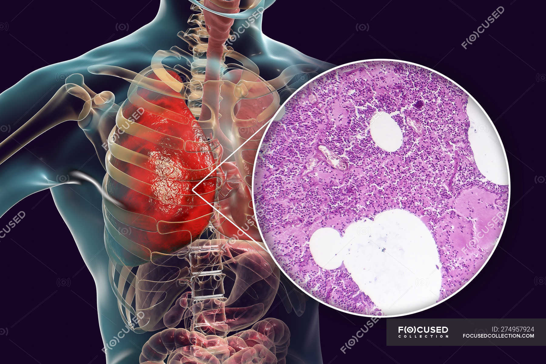 Lobar pneumonia in stage of congestion and consolidation, digital ...