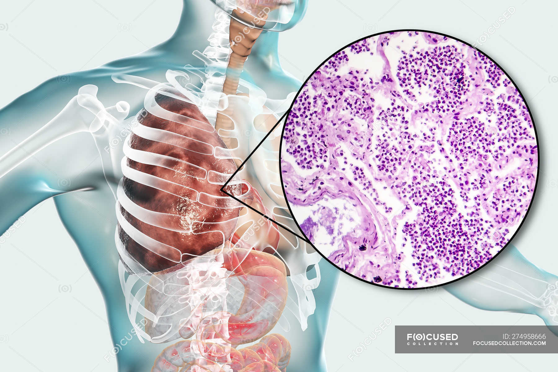 Lobar Pneumonia Stages