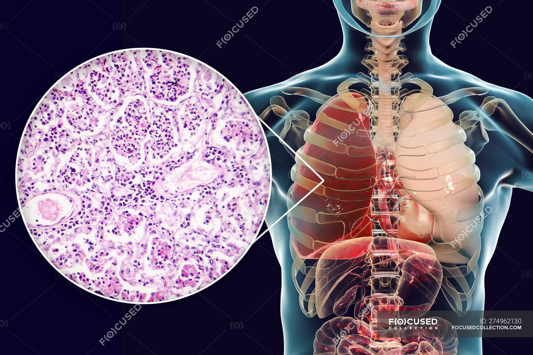 Lobar pneumonia in stage of red hepatisation, digital illustration and ...