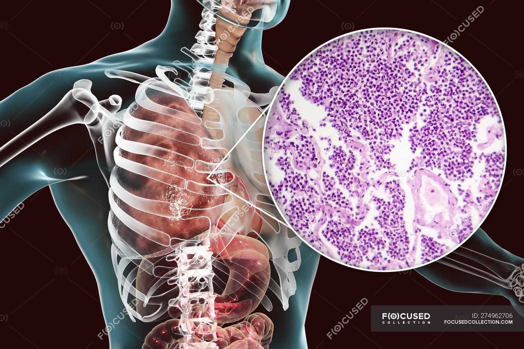 Lobar Pneumonia In Stage Of Grey Hepatisation Or Late Consolidation